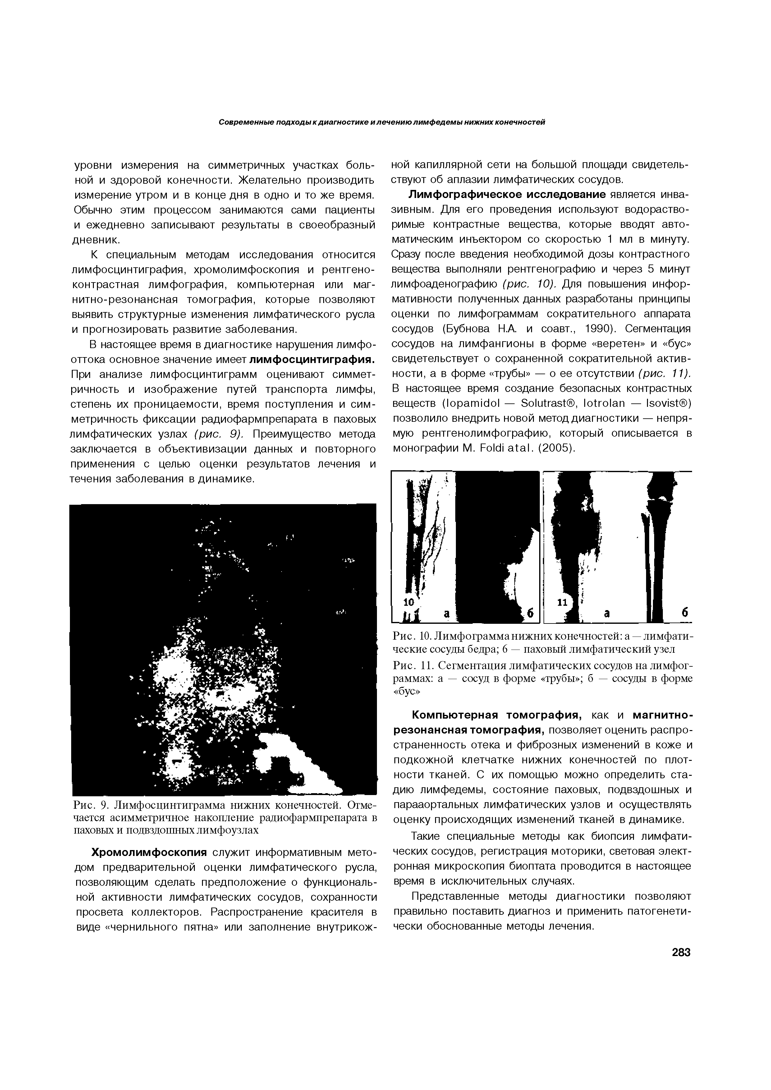 Рис. 10. Лимфограмманижних конечностей а — лимфатические сосуды бедра 6 — паховый лимфатический узел...