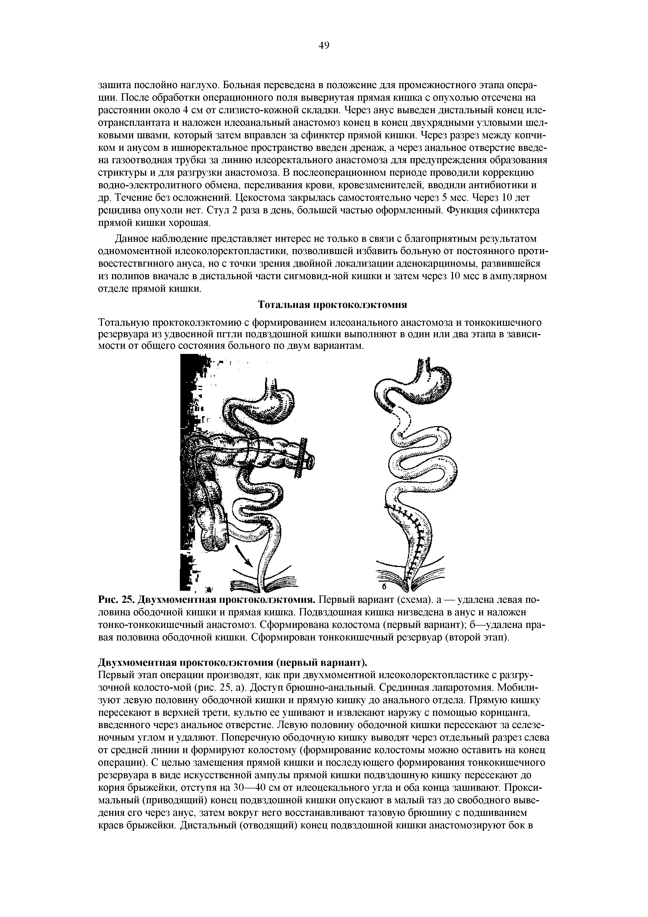 Рис. 25. Двухмоментная проктоколэктомия. Первый вариант (схема), а — удалена левая половина ободочной кишки и прямая кишка. Подвздошная кишка низведена в анус и наложен тонко-тонкокишечный анастомоз. Сформирована колостома (первый вариант) б—удалена правая половина ободочной кишки. Сформирован тонко кишечный резервуар (второй этап).