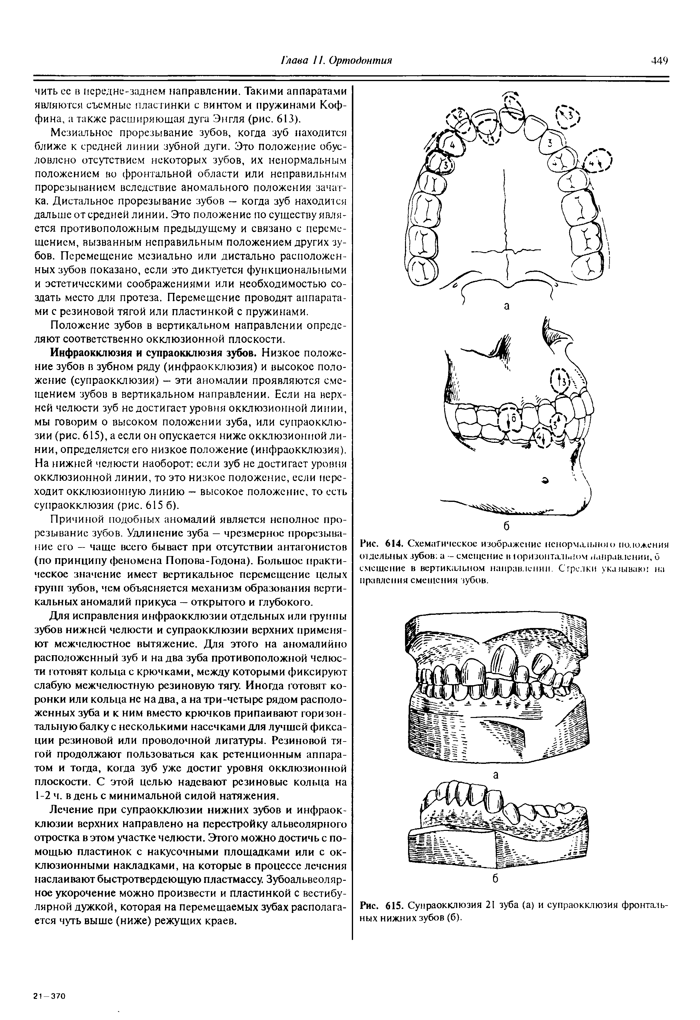 Рис. 615. Сунраокклюзия 21 зуба (а) и супраокклюзия фронтальных нижних зубов (б).