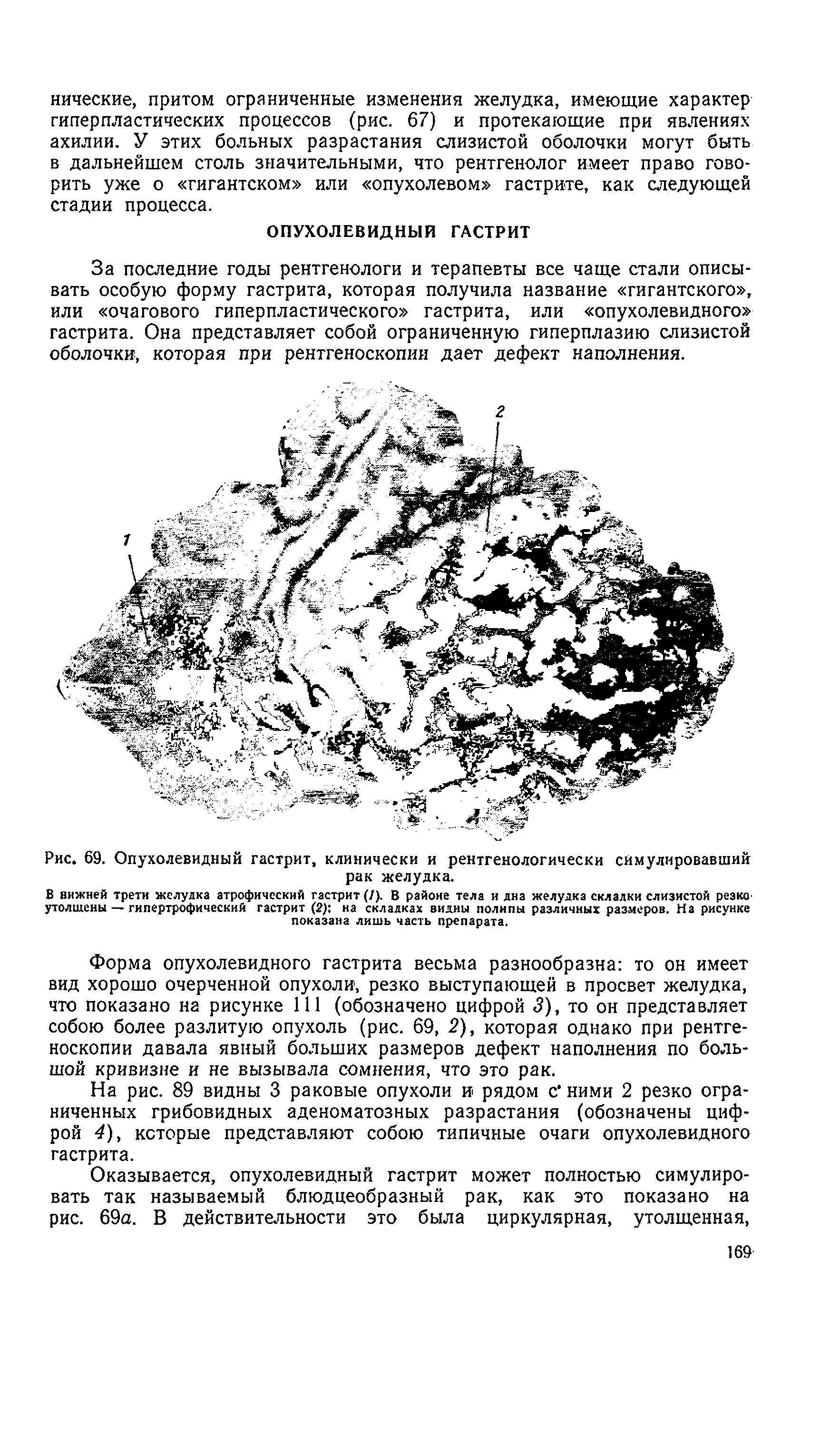 Рис. 69. Опухолевидный гастрит, клинически и рентгенологически симулировавший рак желудка.