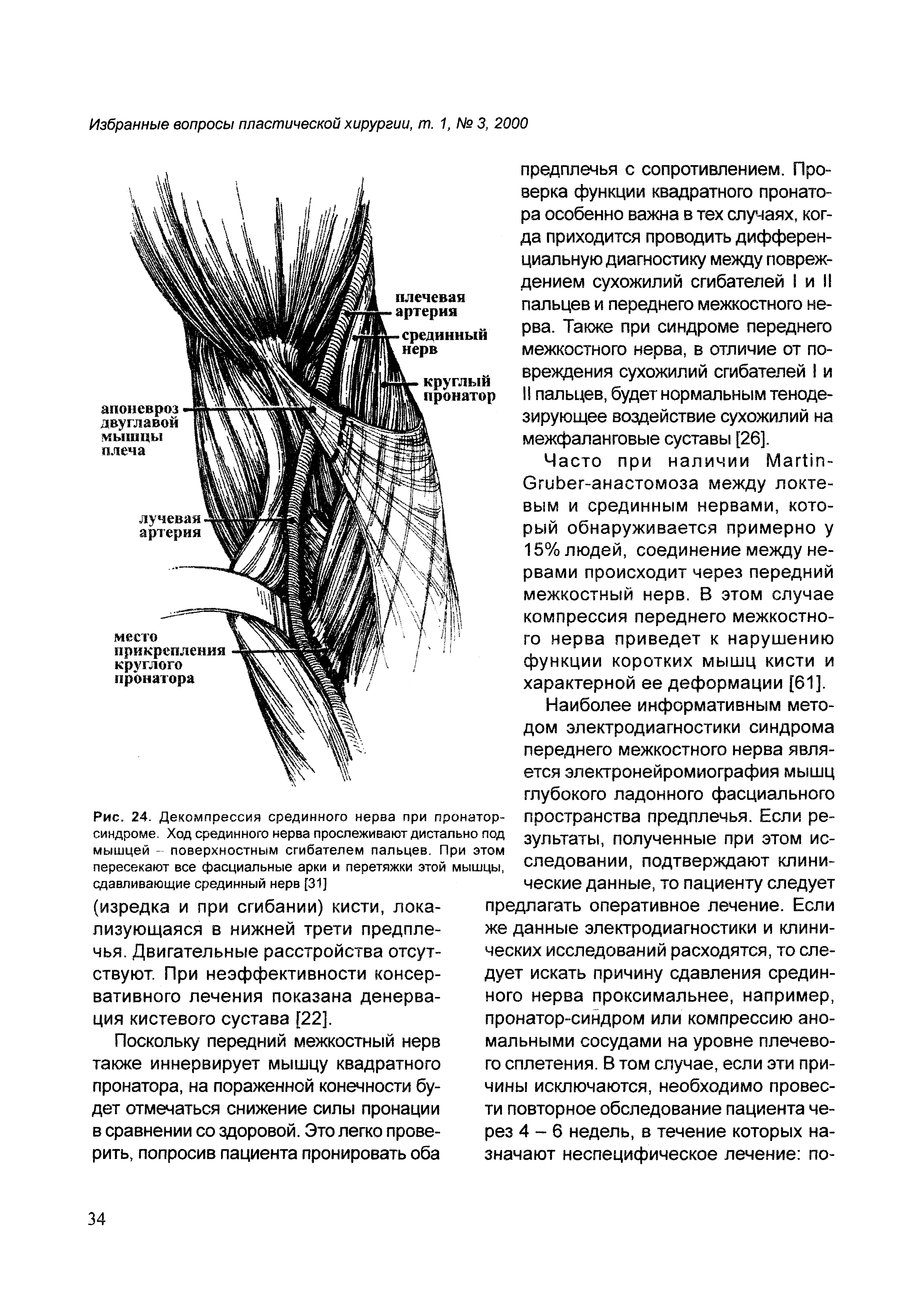 Рис. 24. Декомпрессия срединного нерва при пронатор-синдроме. Ход срединного нерва прослеживают дистально под мышцей - поверхностным сгибателем пальцев. При этом пересекают все фасциальные арки и перетяжки этой мышцы, сдавливающие срединный нерв [31]...