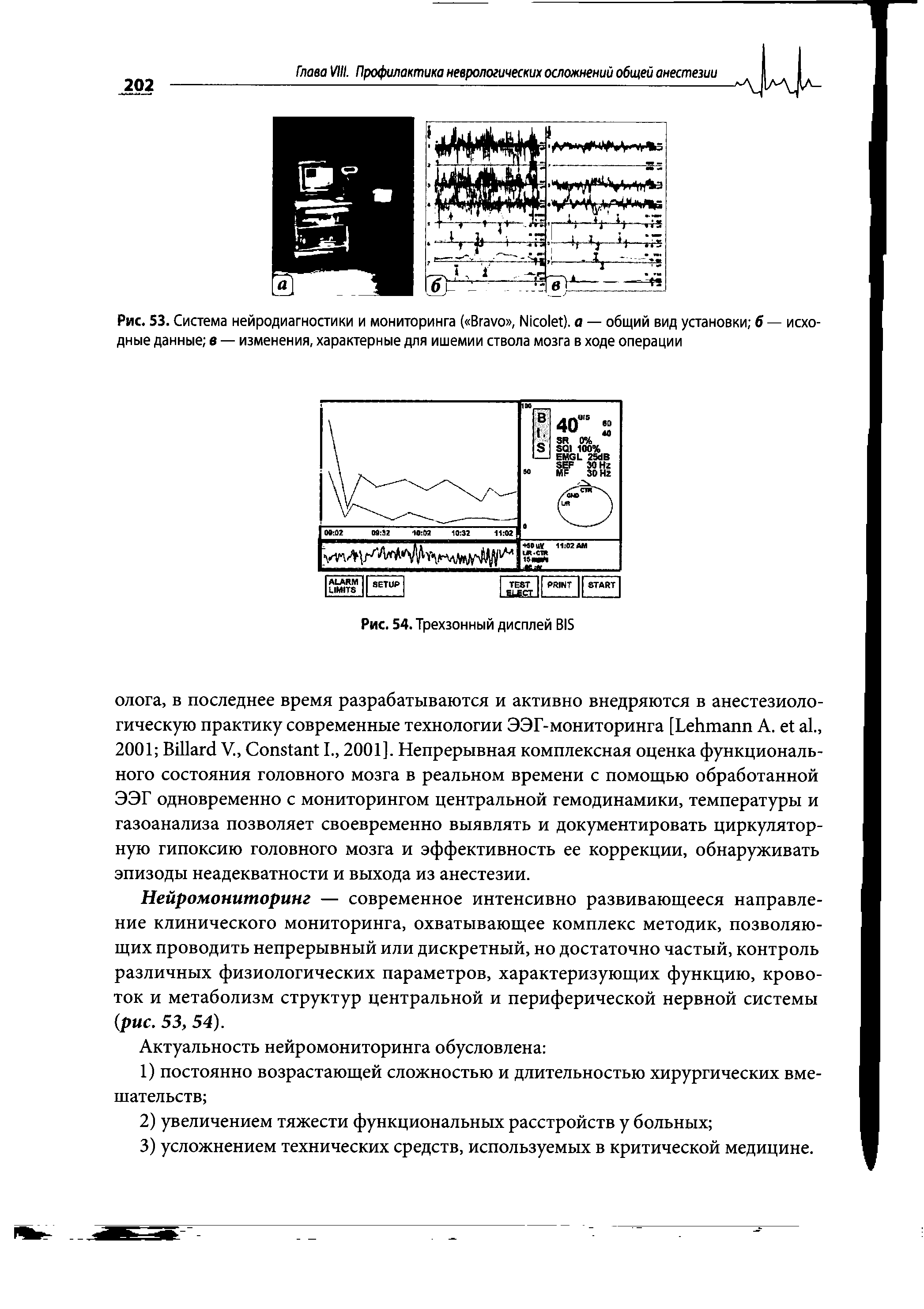 Рис. 53. Система нейродиагностики и мониторинга ( B , N ). а — общий вид установки б — исходные данные в — изменения, характерные для ишемии ствола мозга в ходе операции...