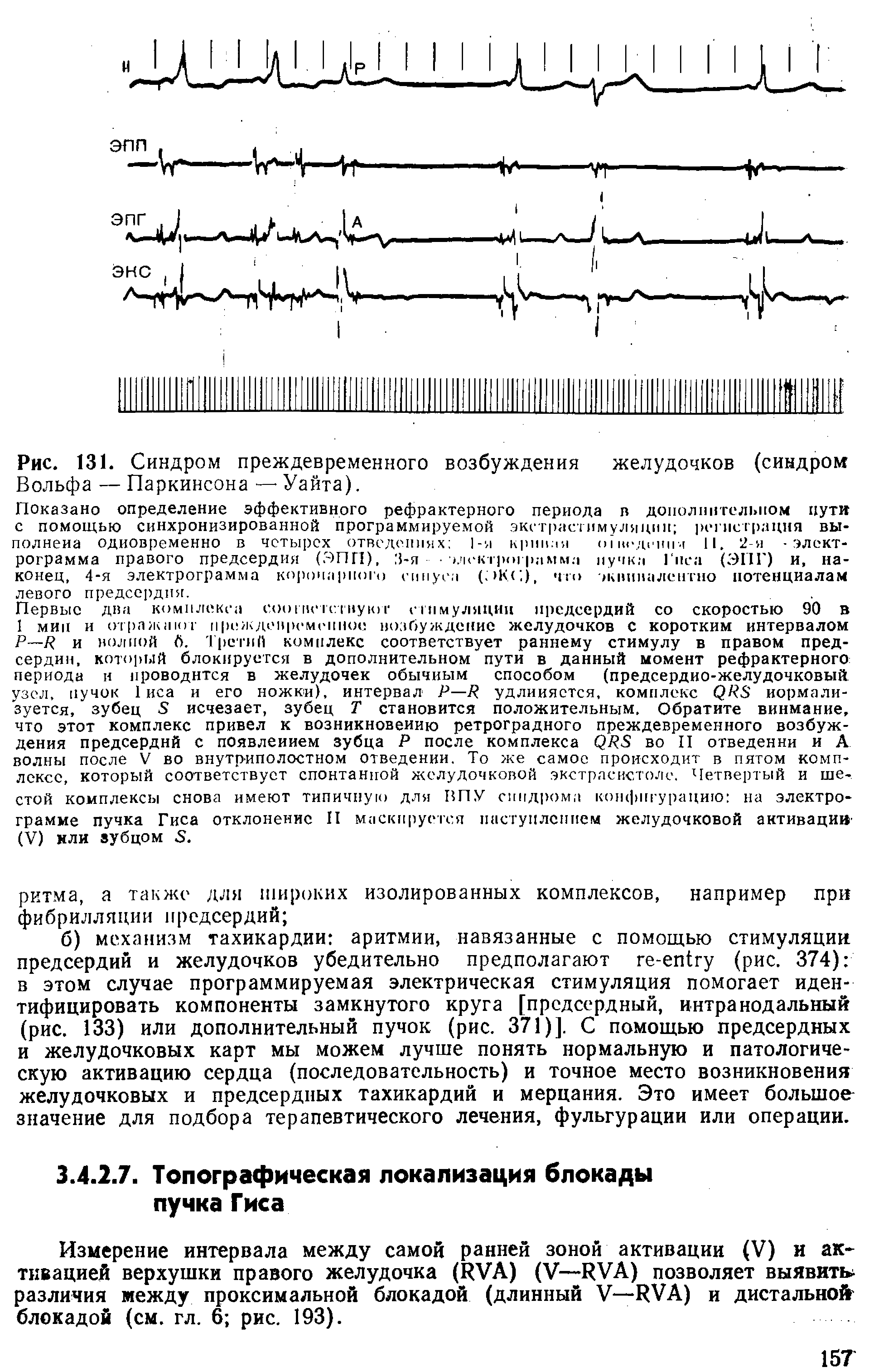 Рис. 131. Синдром преждевременного возбуждения желудочков (синдром Вольфа — Паркинсона — Уайта).