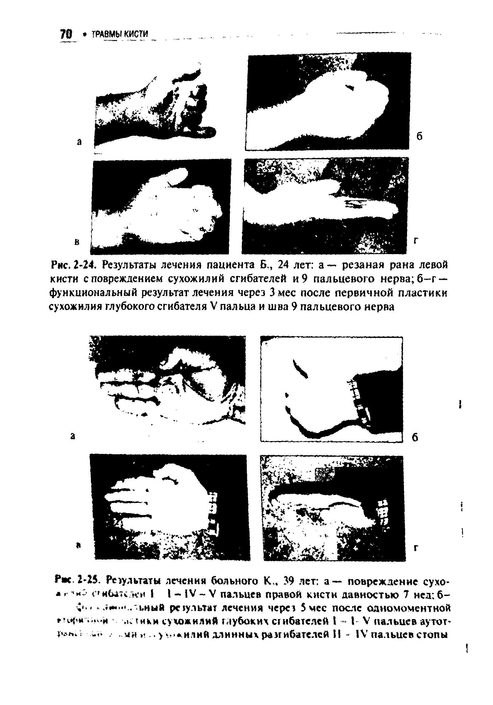 Рис. 2-24. Результаты лечения пациента Б., 24 лет а — резаная рана левой кисти с повреждением сухожилий сгибателей и 9 пальцевого нерва б-г — функциональный результат лечения через Змее после первичной пластики сухожилия глубокого сгибателя V пальца и шва 9 пальцевого нерва...