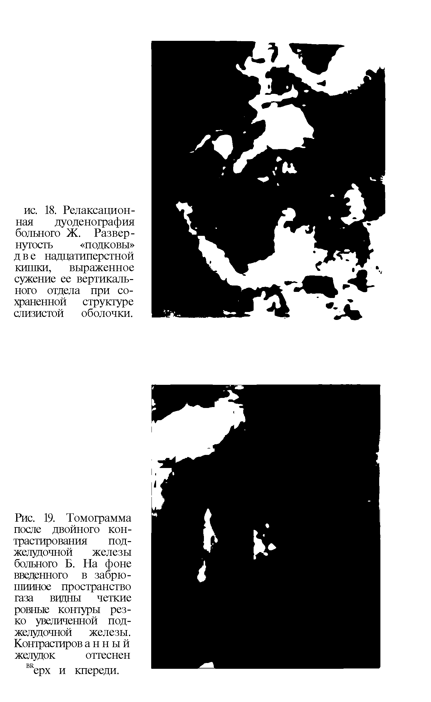 Рис. 19. Томограмма после двойного контрастирования поджелудочной железы больного Б. На фоне введенного в забрюшинное пространство газа вцдны четкие ровные контуры резко увеличенной поджелудочной железы. Контрастиров а н н ы й желудок оттеснен вкерх и кпереди.