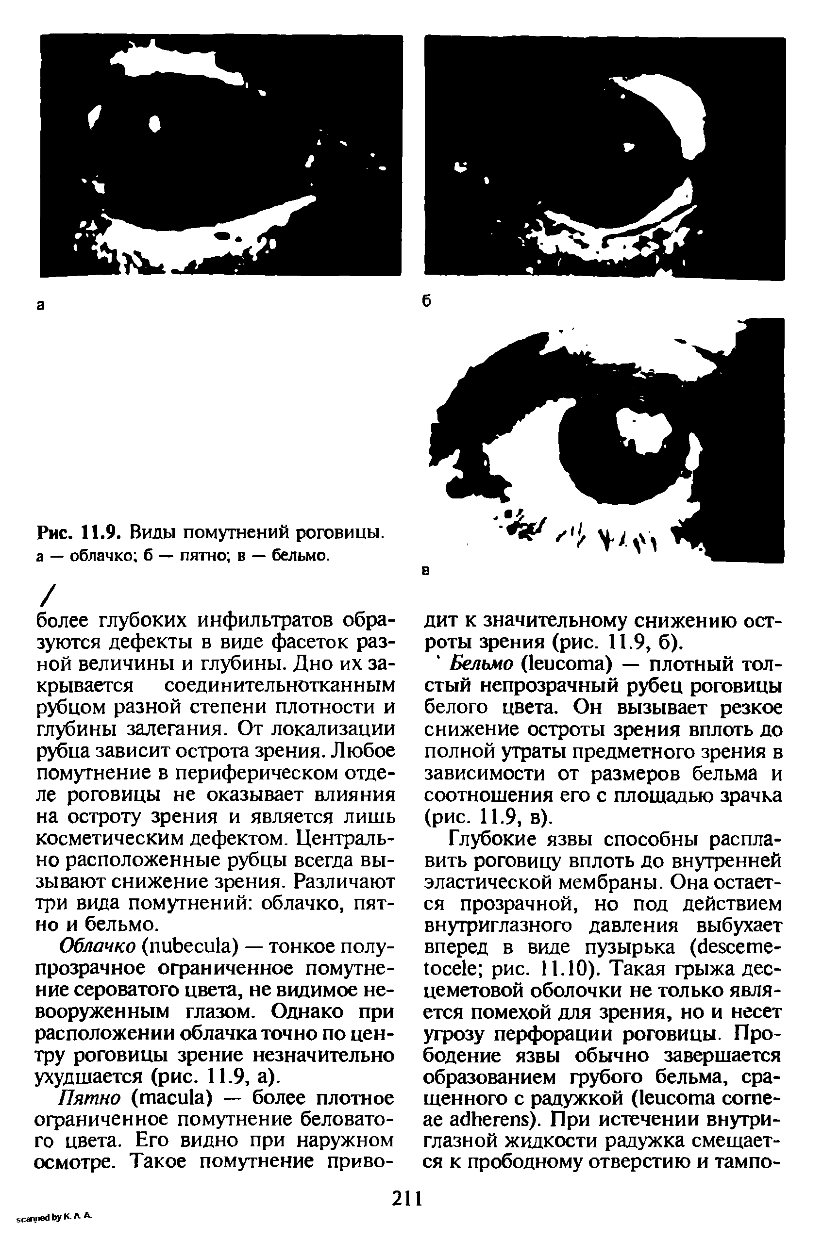 Рис. 11.9. Виды помутнений роговицы, а — облачко б — пятно в — бельмо.