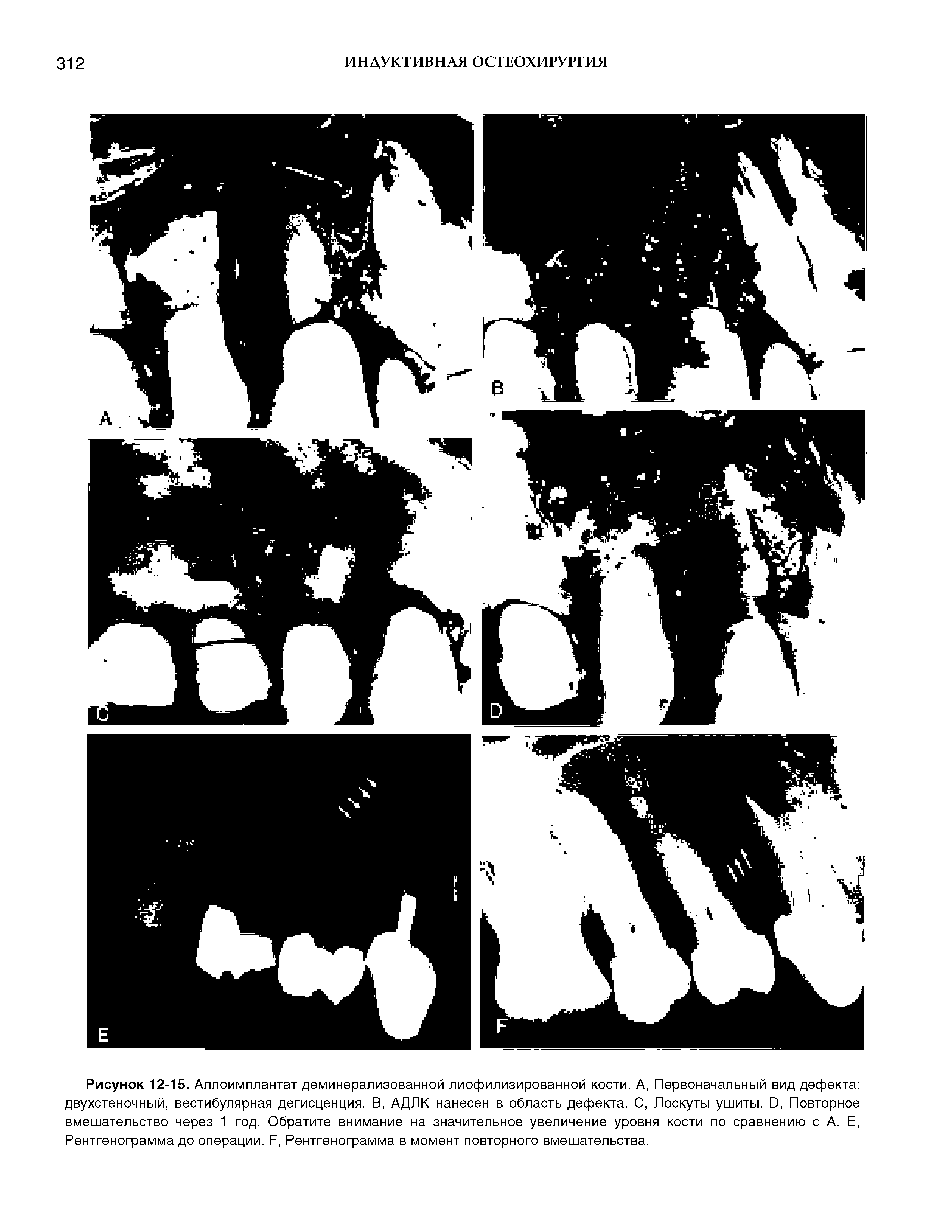Рисунок 12-15. Аллоимплантат деминерализованной лиофилизированной кости. А, Первоначальный вид дефекта двухстеночный, вестибулярная дегисценция. В, АДЛК нанесен в область дефекта. С, Лоскуты ушиты. О, Повторное вмешательство через 1 год. Обратите внимание на значительное увеличение уровня кости по сравнению с А. Е, Рентгенограмма до операции. Л, Рентгенограмма в момент повторного вмешательства.
