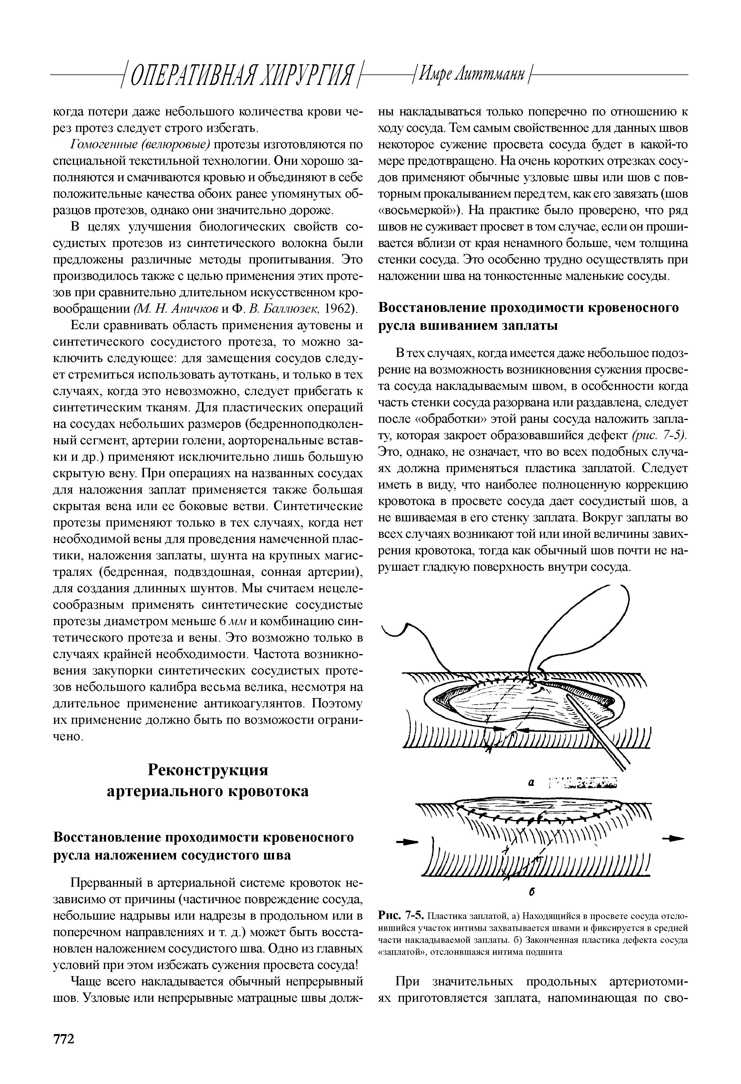 Рис. 7-5. Пластика заплатой, а) Находящийся в просвете сосуда отслоившийся участок интимы захватывается швами и фиксируется в средней части накладываемой заплаты, б) Законченная пластика дефекта сосуда заплатой , отслоившаяся интима подшита...