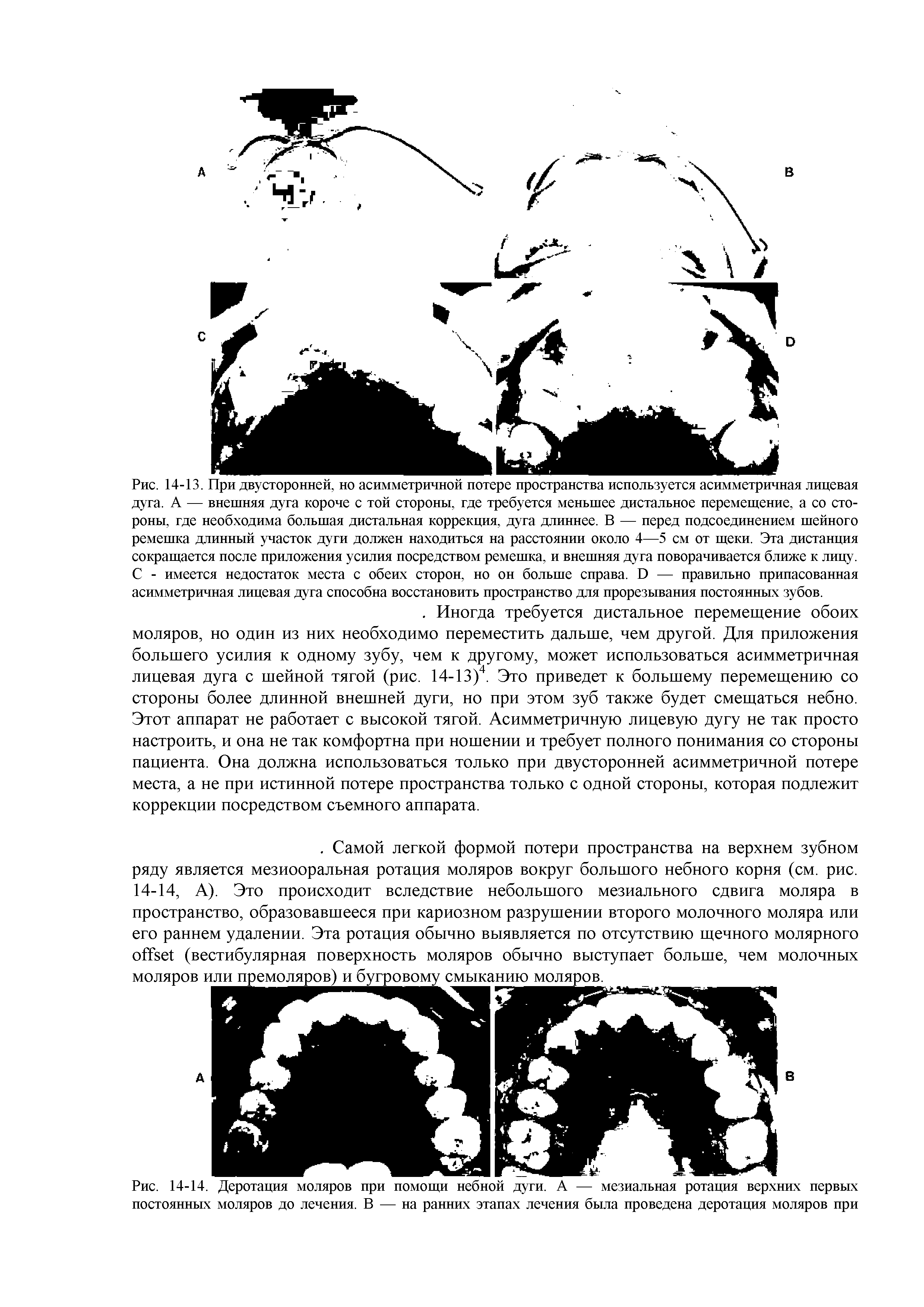 Рис. 14-14. Деротация моляров при помощи небной дуги. А — мезиальная ротация верхних первых постоянных моляров до лечения. В — на ранних этапах лечения была проведена деротация моляров при...