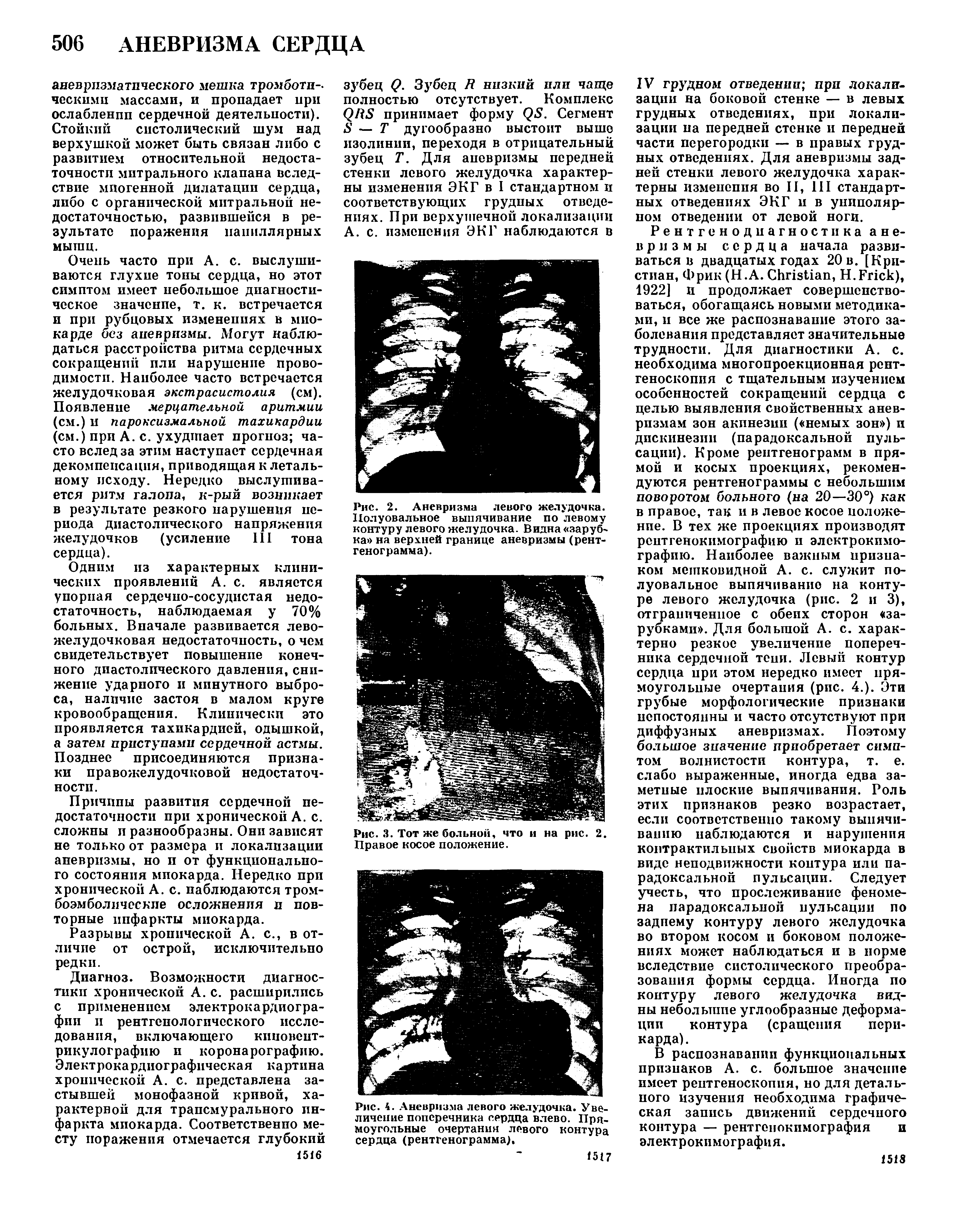 Рис. 4. Аневризма левого желудочка. Увеличение поперечника сердца влево. Прямоугольные очертания левого контура сердца (рентгенограмма).