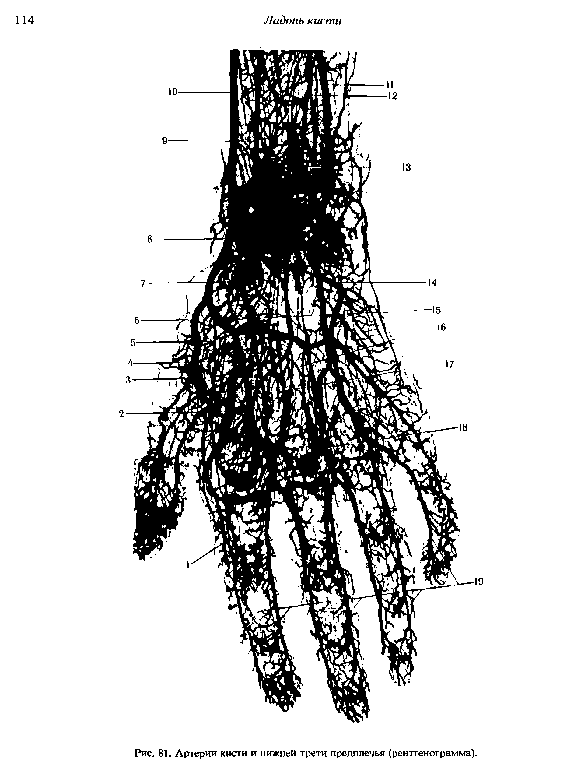 Рис. 81. Артерии кисти и нижней трети предплечья (рентгенограмма).