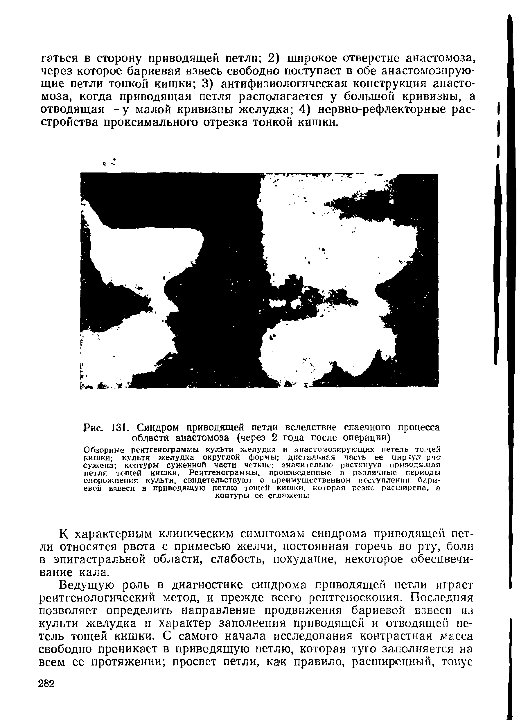 Рис. 131. Синдром приводящей петли вследствие спаечного процесса области анастомоза (через 2 года после операции)...