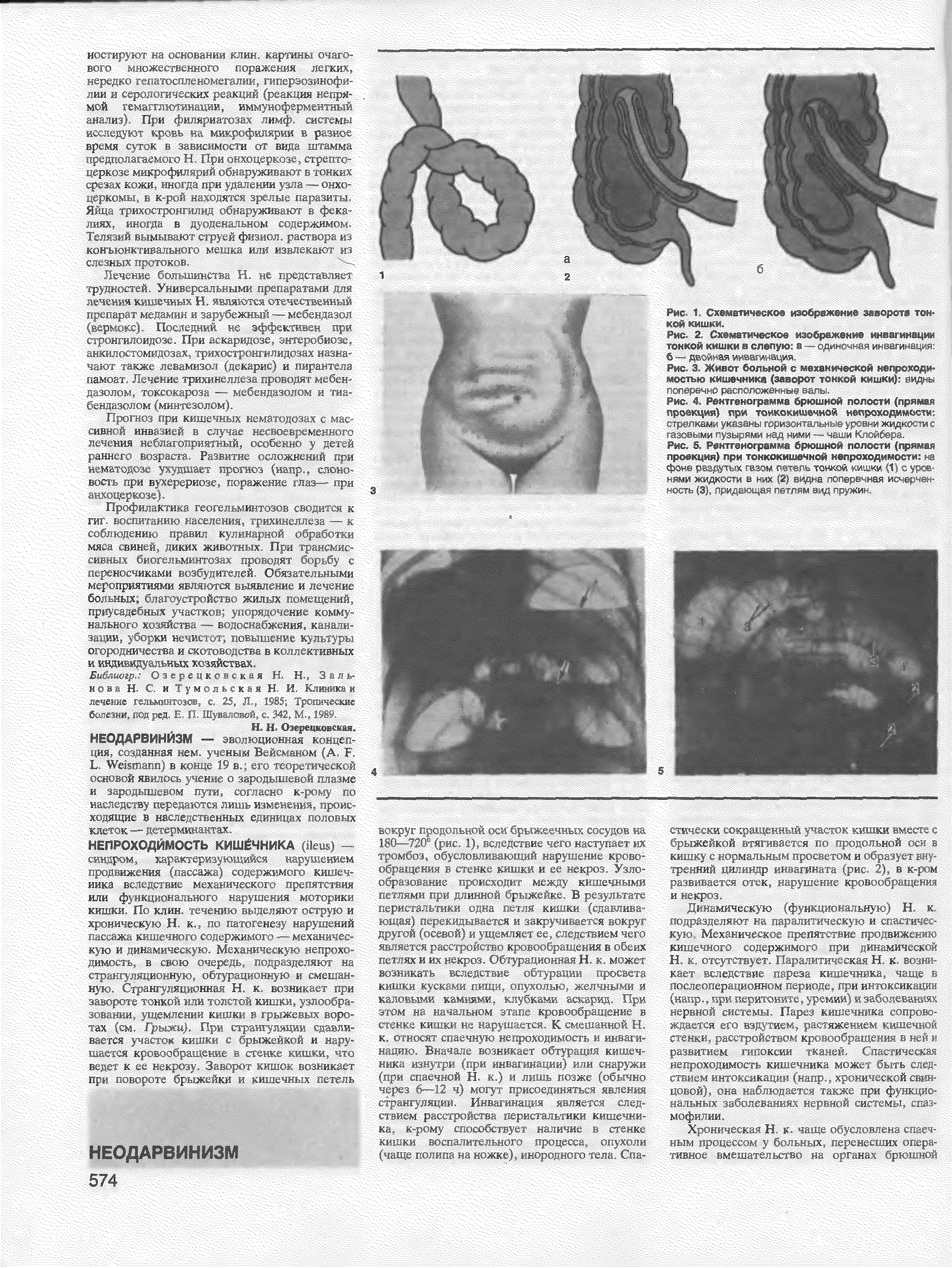 Рис. 2. Схематическое изображение инвагинации ТОНКОЙ КИШКИ И слепую Я - ДиН ч К ИкМИУШИ б - ДВ Ж1 ая №А№ Л 1ЩИЯ.