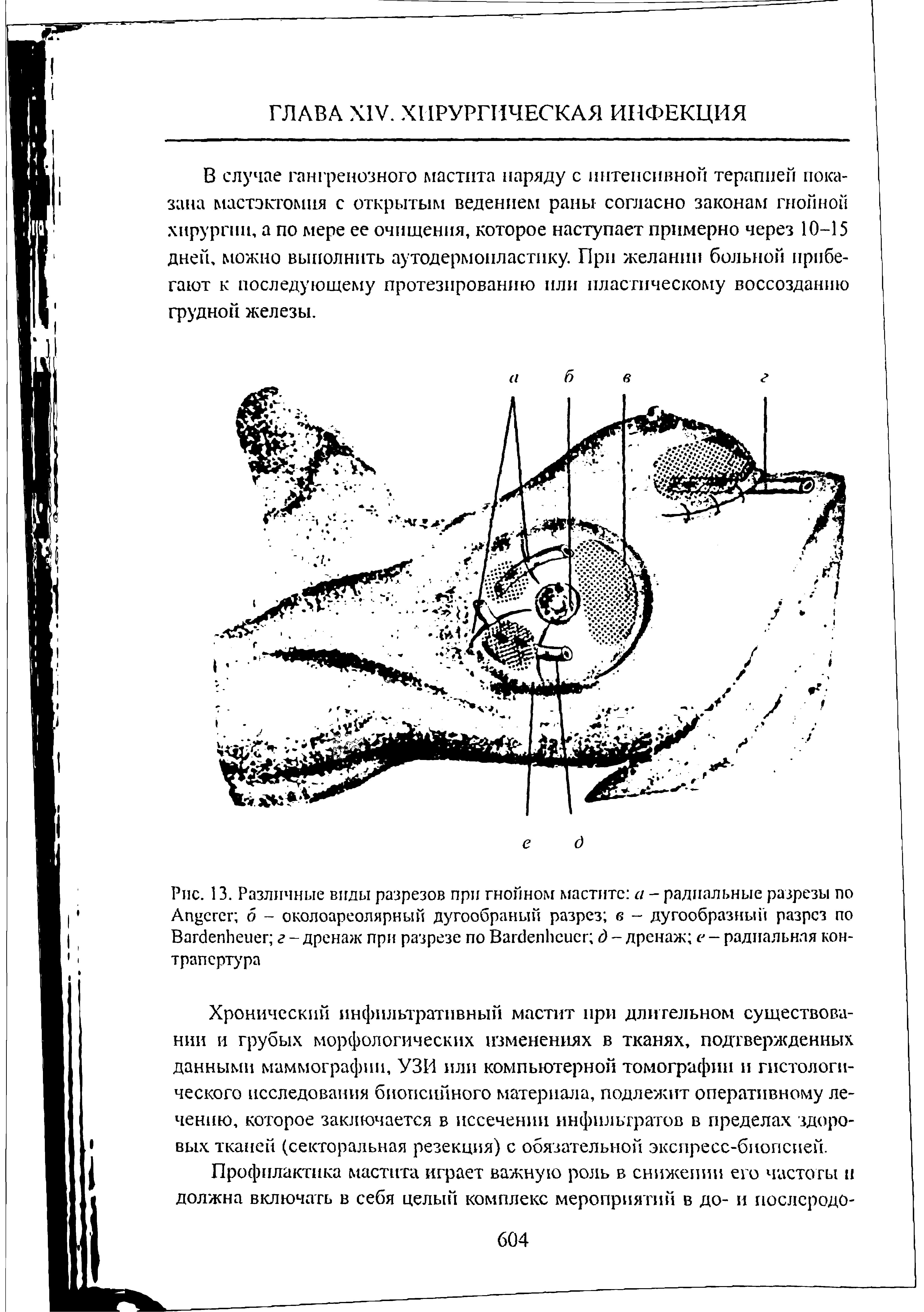 Рис. 13. Различные виды разрезов при гнойном мастите а - радиальные разрезы по Ап сгсг б - околоареолярный дугообраный разрез в - дугообразный разрез по Вагбепйеиег г - дренаж при разрезе по ВагйепЬсисг д - дренаж е — радиальная контрапертура...