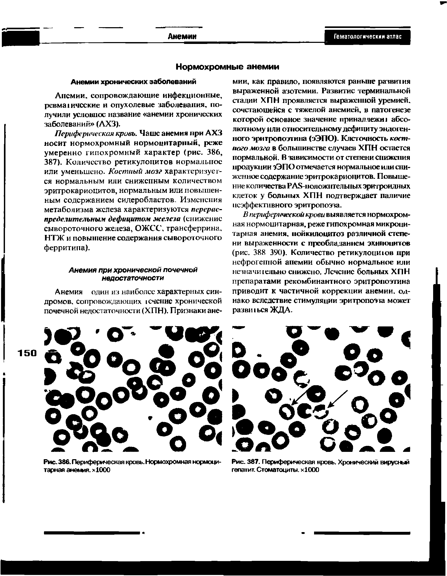 Рис. 387. Периферическая кровь. Хроническим вирусный гепатит. Стоматоциты. х1000...