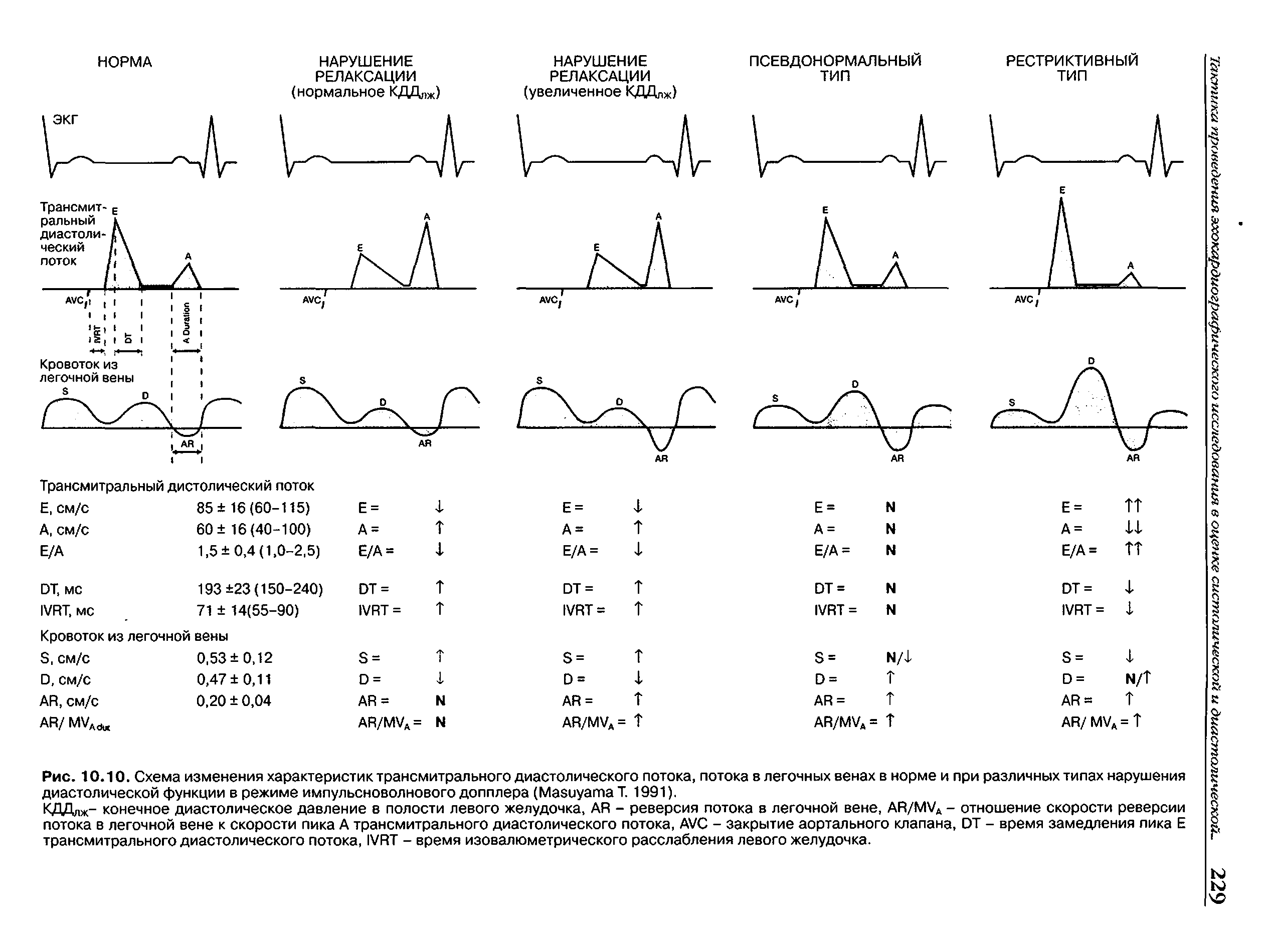 Рис. 10.10. Схема изменения характеристик трансмитрального диастолического потока, потока в легочных венах в норме и при различных типах нарушения диастолической функции в режиме импульсноволнового допплера (МавиуатаТ. 1991).