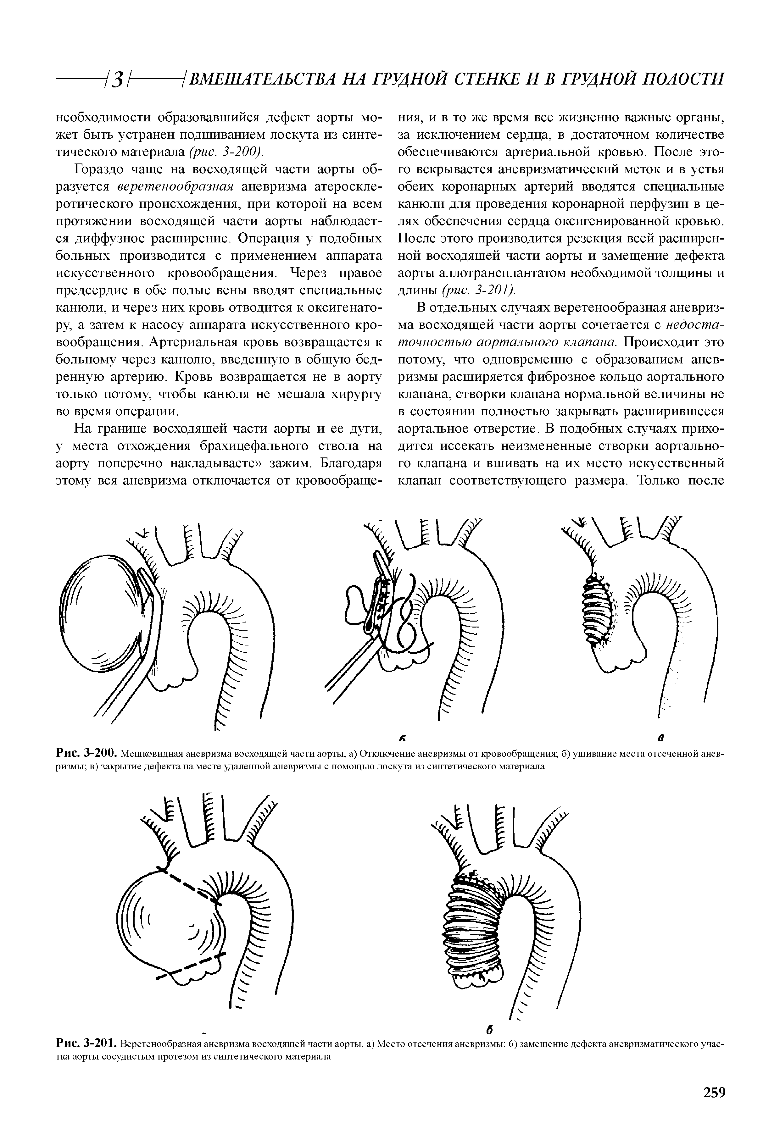 Рис. 3-201. Веретенообразная аневризма восходящей части аорты, а) Место отсечения аневризмы 6) замещение дефекта аневризматического участка аорты сосудистым протезом из синтетического материала...