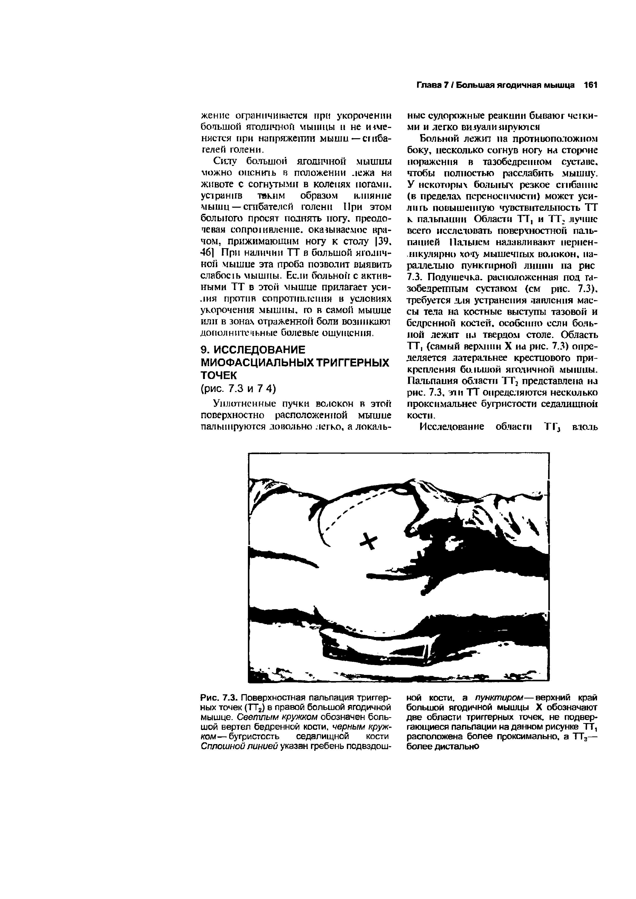 Рис. 7.3. Поверхностная пальпация триггерных точек (ТТ2) в правой большой ягодичной мышце. Светлым кружком обозначен большой вертел бедренной кости, черным кружком— бугристость седалищной кости Сплошной линией указан гребень подвздош...