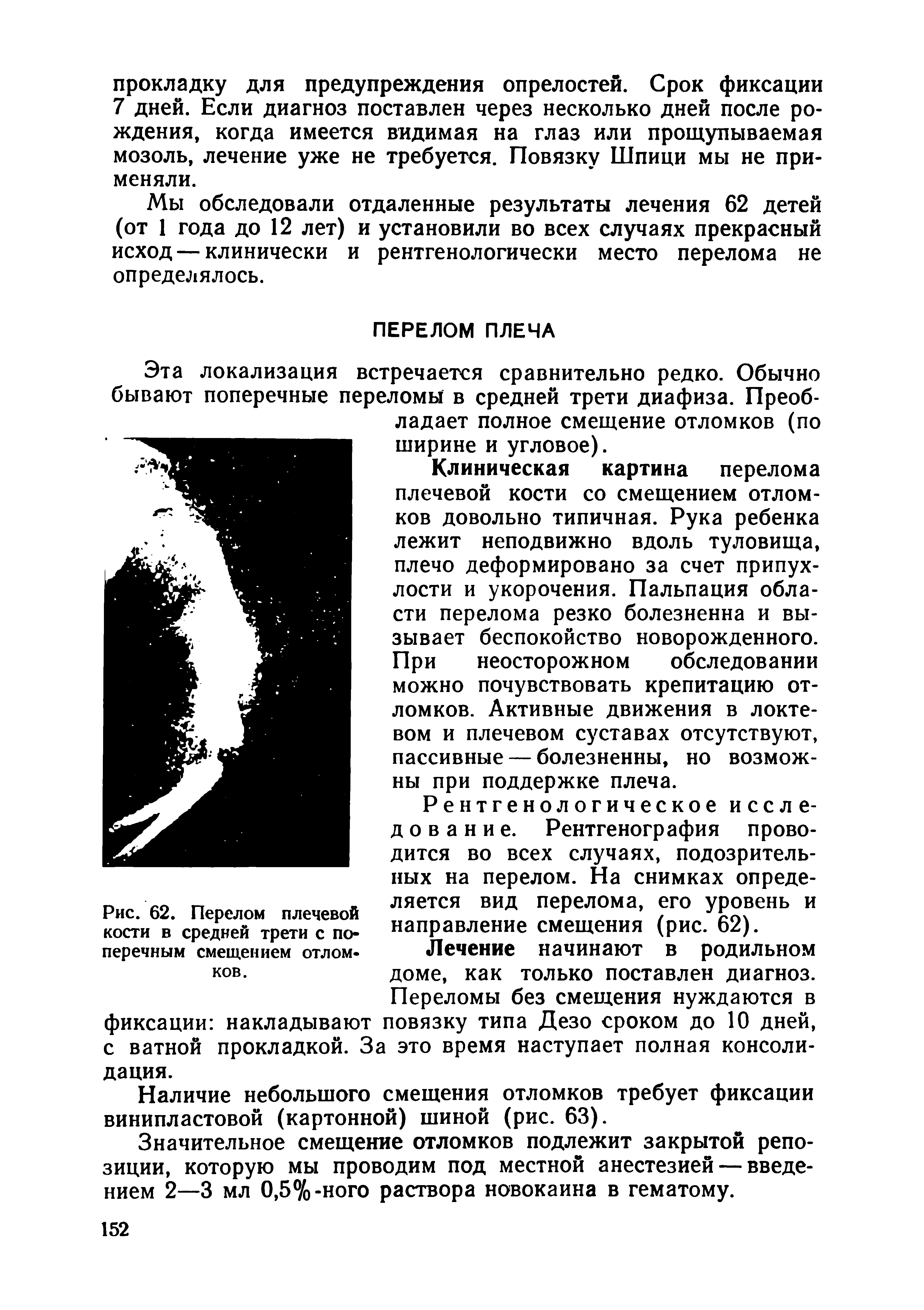 Рис. 62. Перелом плечевой кости в средней трети с поперечным смещением отломков.