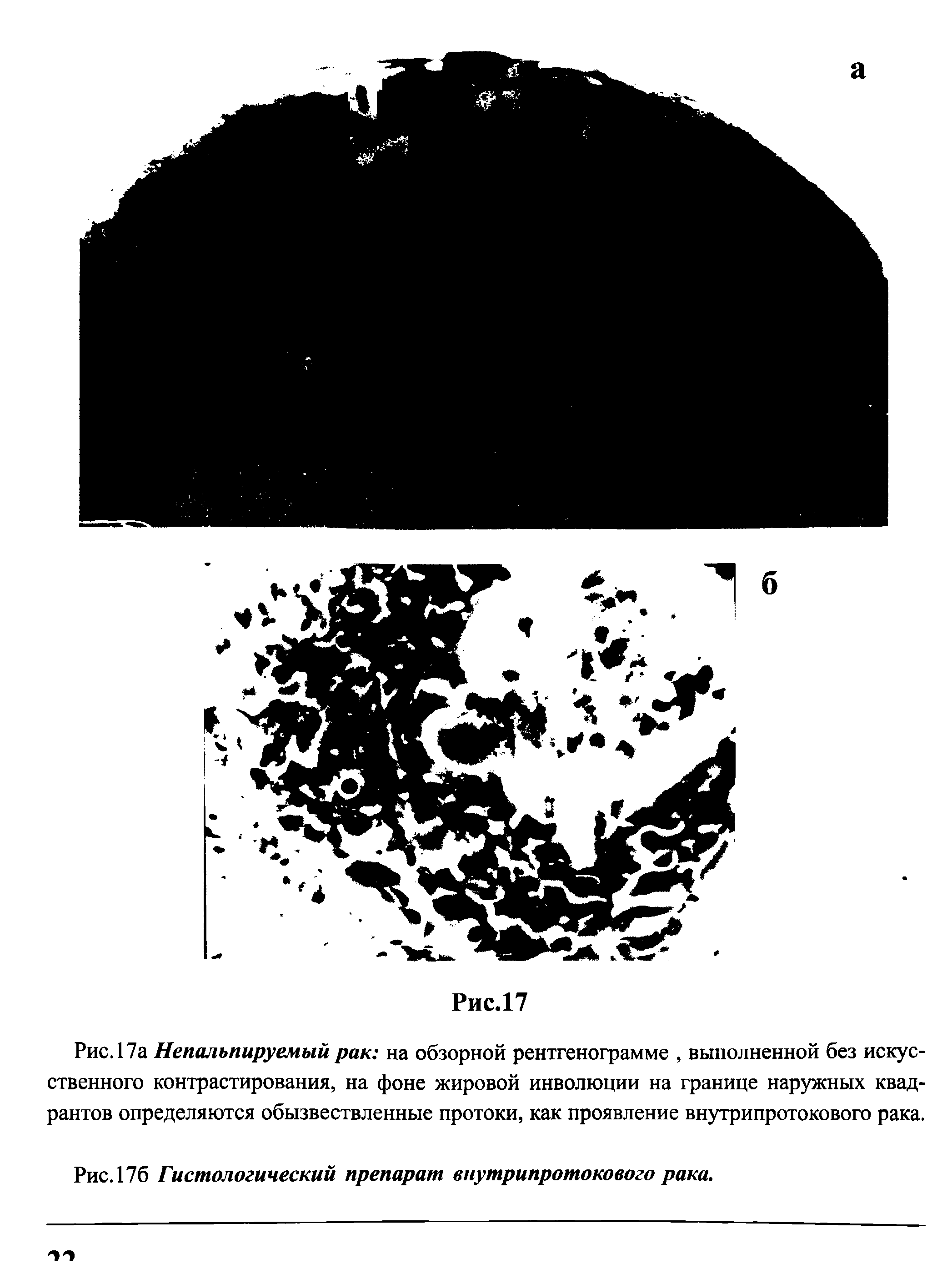 Рис. 17а Непальпируемый рак на обзорной рентгенограмме, выполненной без искусственного контрастирования, на фоне жировой инволюции на границе наружных квадрантов определяются обызвествленные протоки, как проявление внутрипротокового рака.