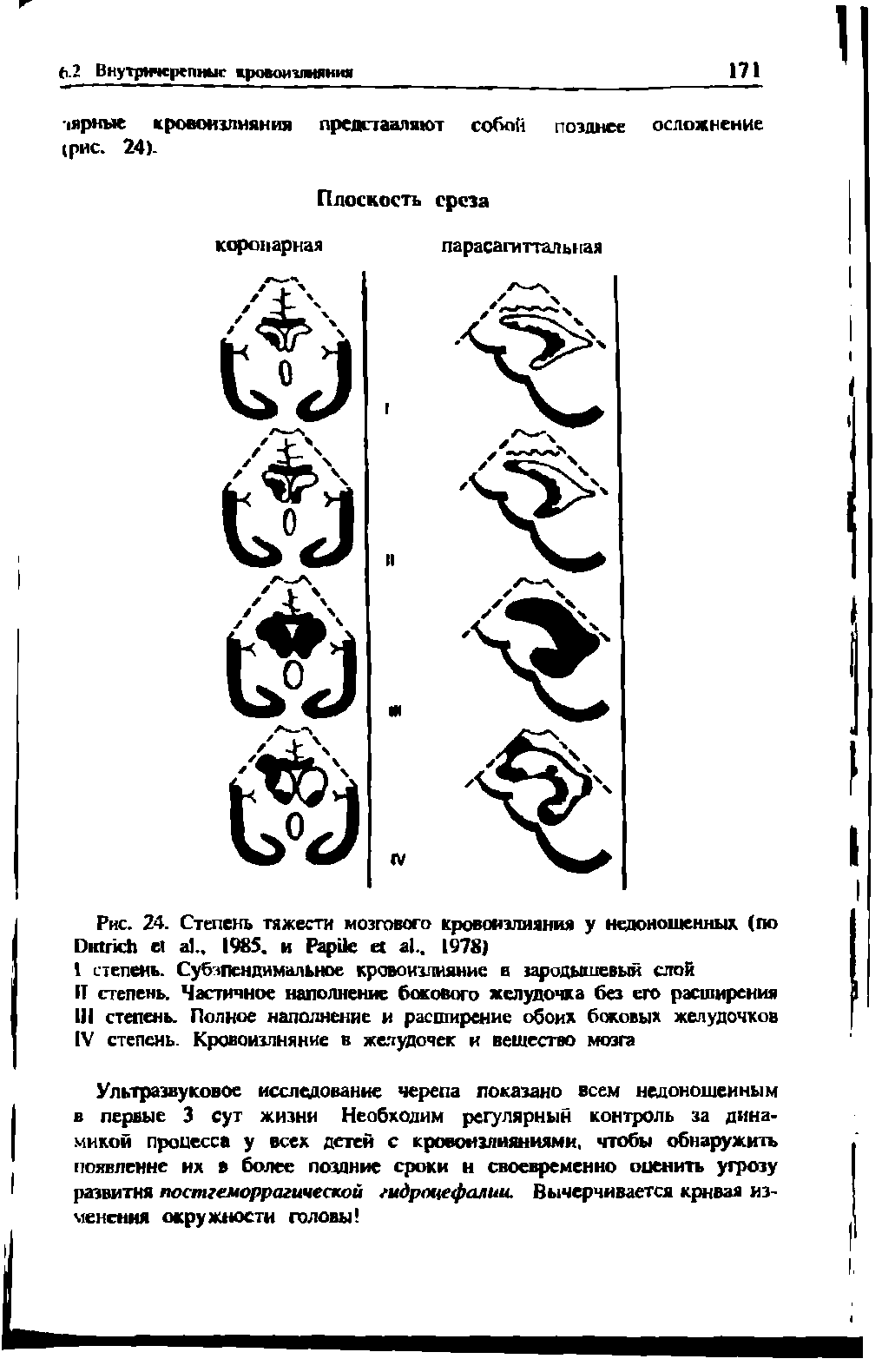 Рис. 24. Степень тяжести мозгового кровоизлияния у недоношенных (по D .. 198. и P . 1978)...