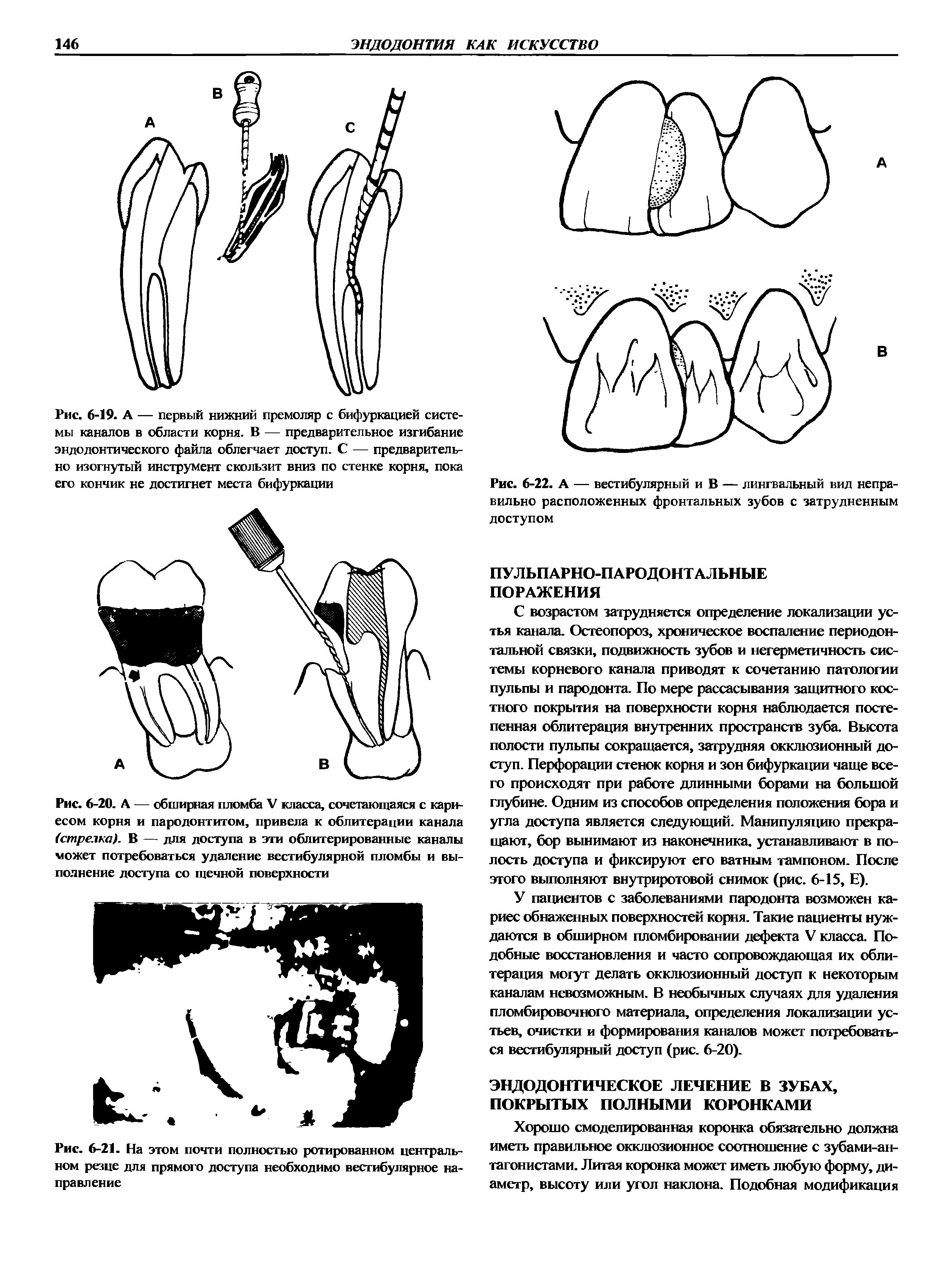 Рис. 6-20. А — обширная пломба V класса, сочетающаяся с кариесом корня и пародонтитом, привела к облитерации канала (стрелка). В — для доступа в эти облитерированные каналы может потребоваться удаление вестибулярной пломбы и выполнение доступа со щечной поверхности...