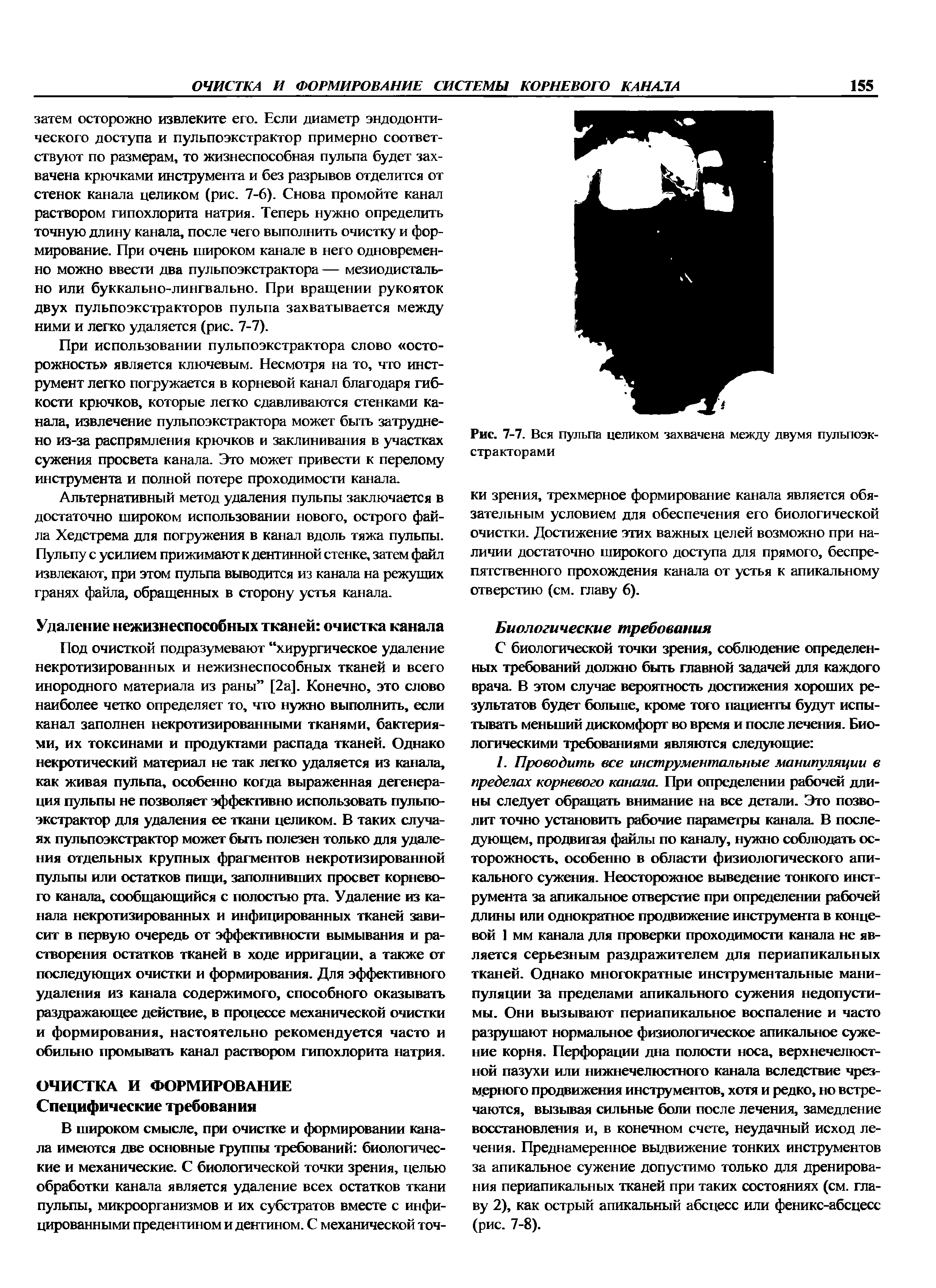 Рис. 7-7. Вся пульпа целиком захвачена между двумя пульпоэкстракторами...