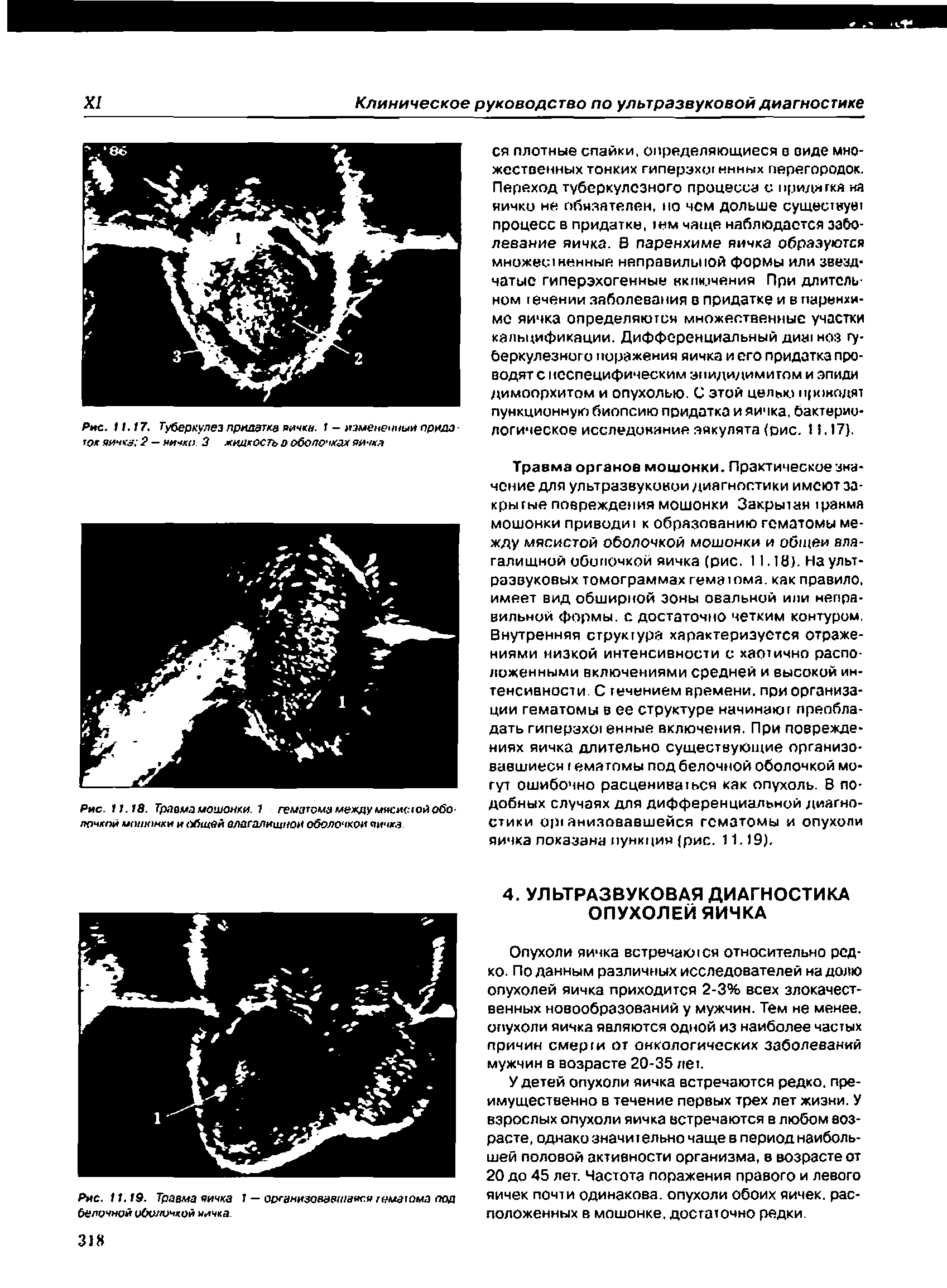 Рис. 11.18. Травма мошонки. 1 гематомамеждумясисюйобо-почкой мошонки и общей влагалищной оболочкой яичка...