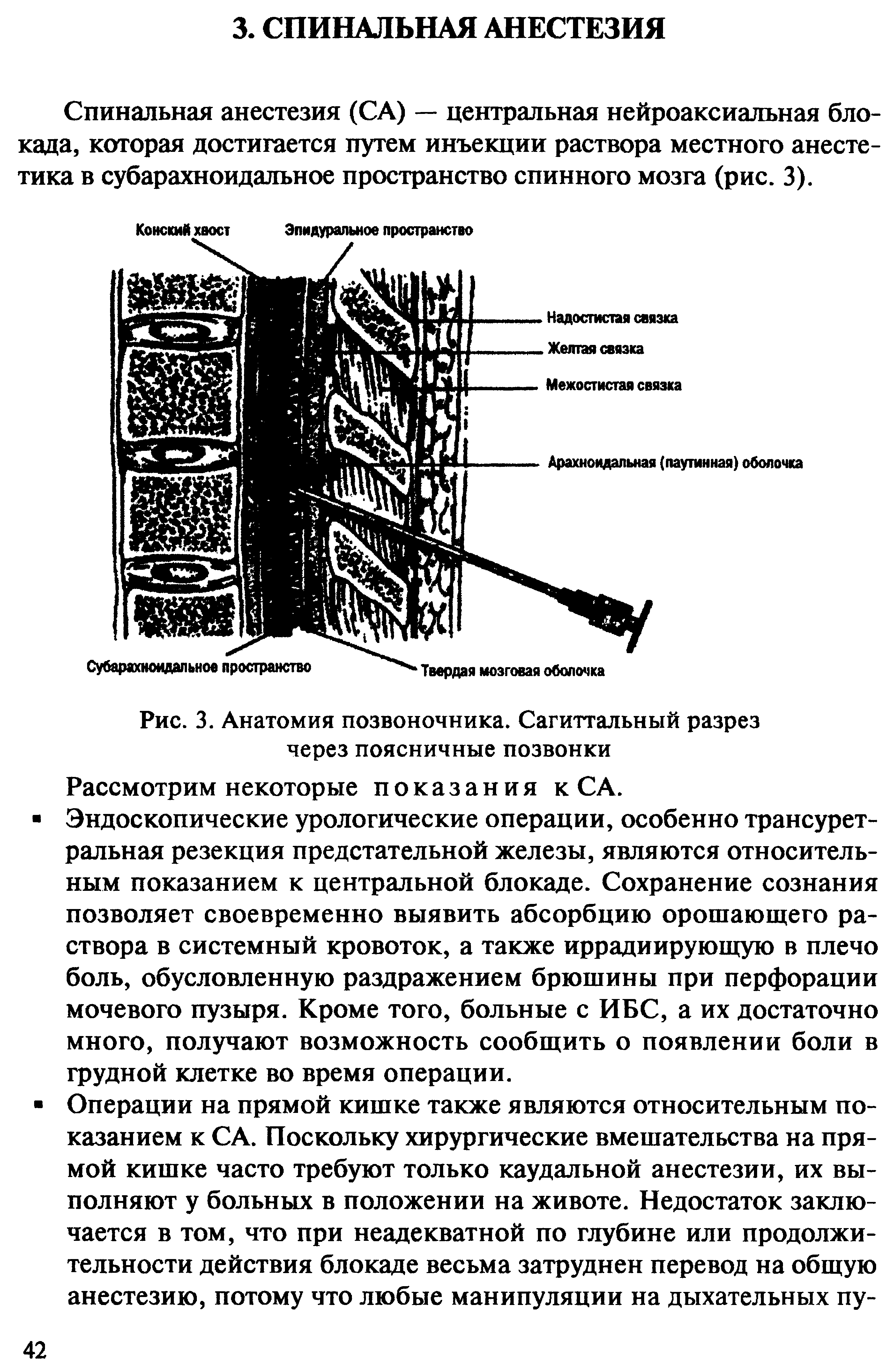 Рис. 3. Анатомия позвоночника. Сагиттальный разрез через поясничные позвонки Рассмотрим некоторые показания к СА.