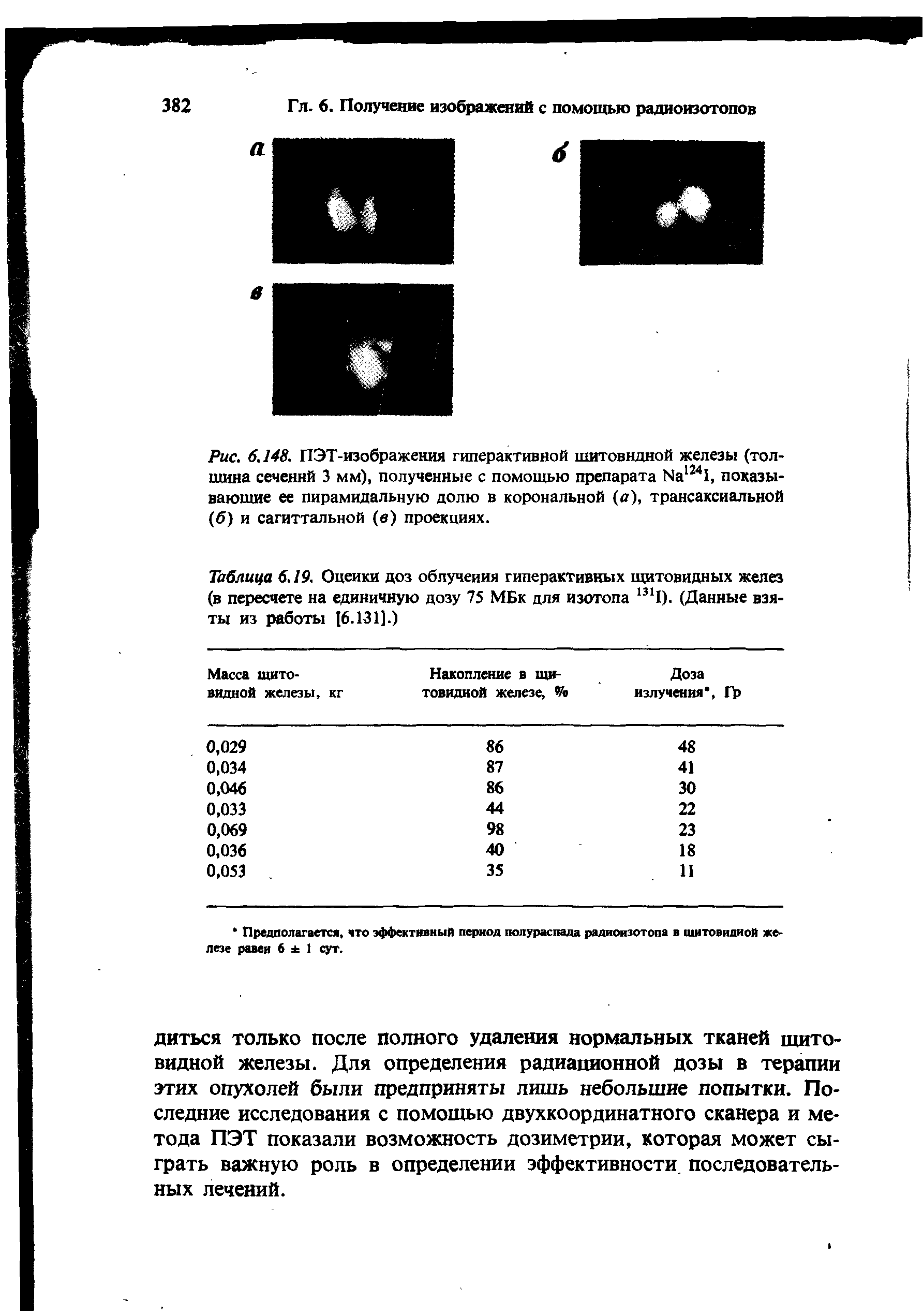 Рис. 6.148. ПЭТ-изображения гиперактивной щитовидной железы (толщина сеченнй 3 мм), полученные с помощью препарата №1241, показывающие ее пирамидальную долю в корональной (а), трансаксиальной (б) и сагиттальной (в) проекциях.