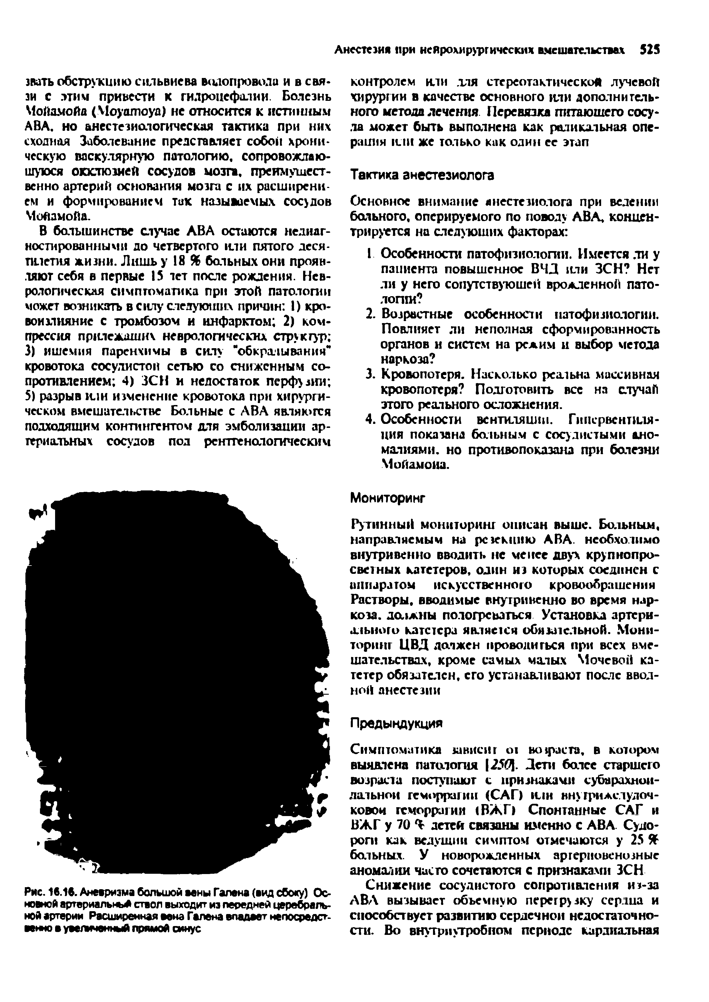 Рис. 18.16. Аневризма большой вены Галена (вид сбоку) Основной артериальный ствол выходит из передней церебральной артерии Расширенная вена Галена впадает непосредственно в увегмченный прямой синус...