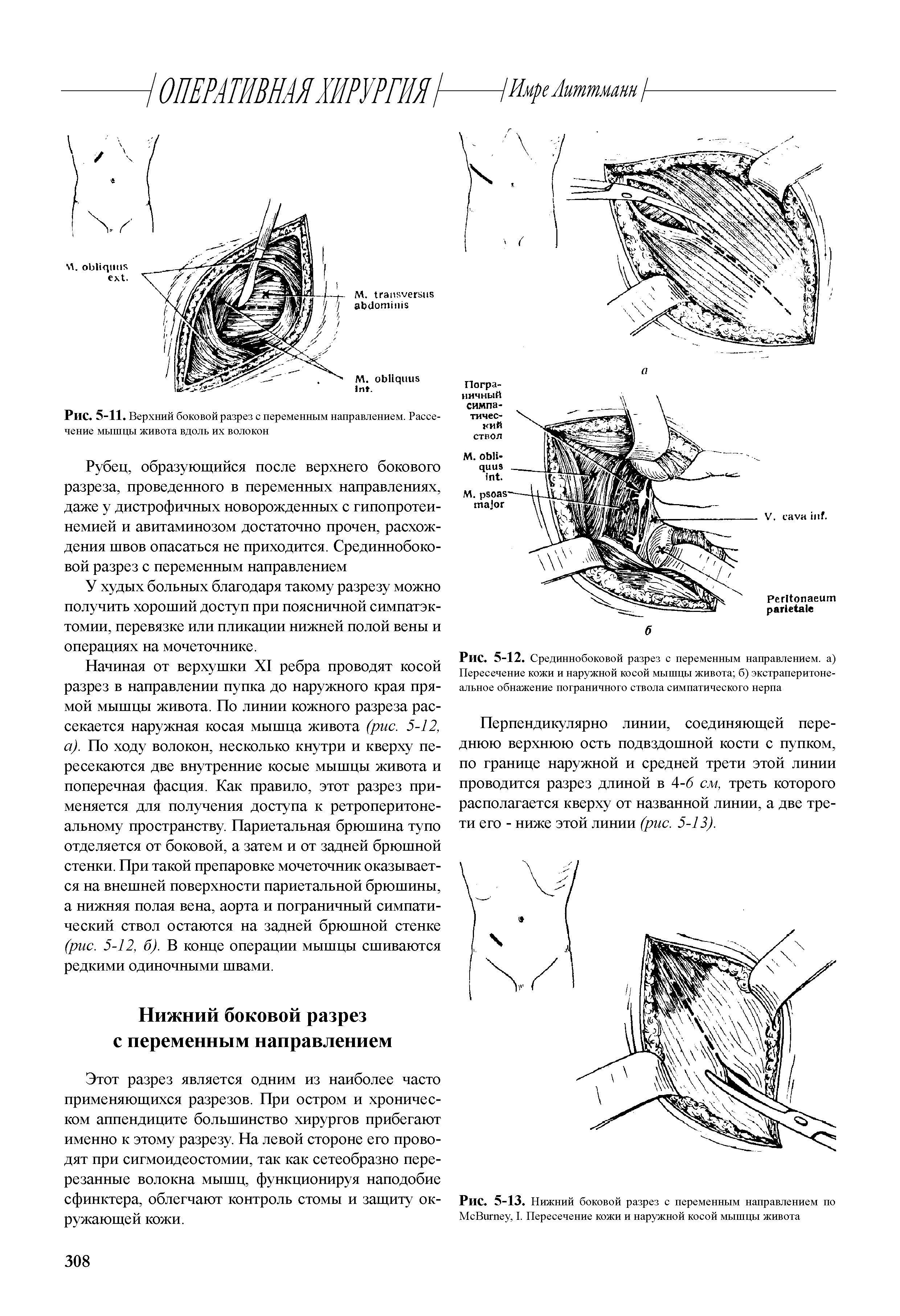 Рис. 5-13. Нижний боковой разрез с переменным направлением по M B , I. Пересечение кожи и наружной косой мышцы живота...