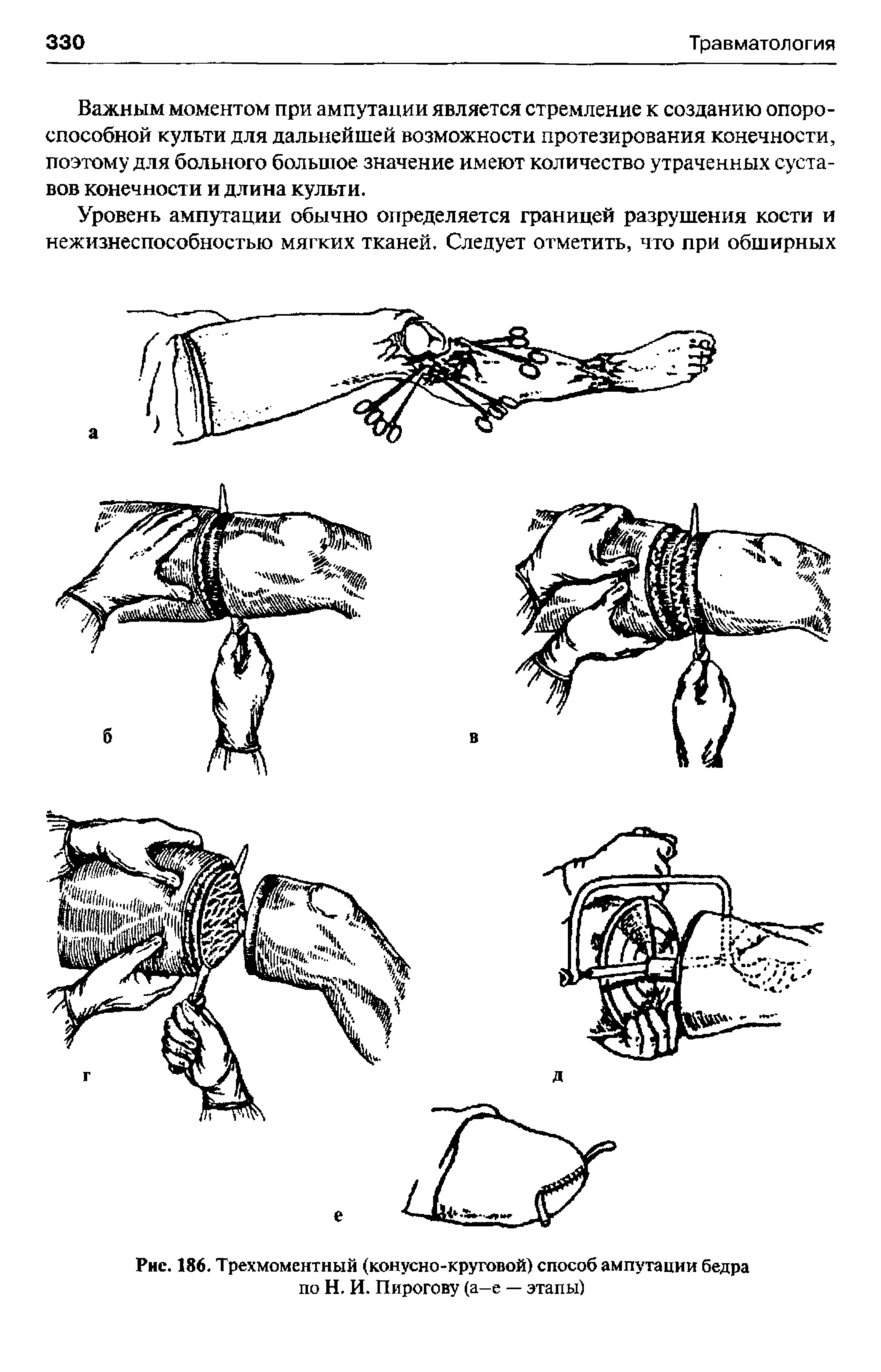 Рис. 186. Трехмоментный (конусно-круговой) способ ампутации бедра по Н. И. Пирогову (а-е — этапы)...