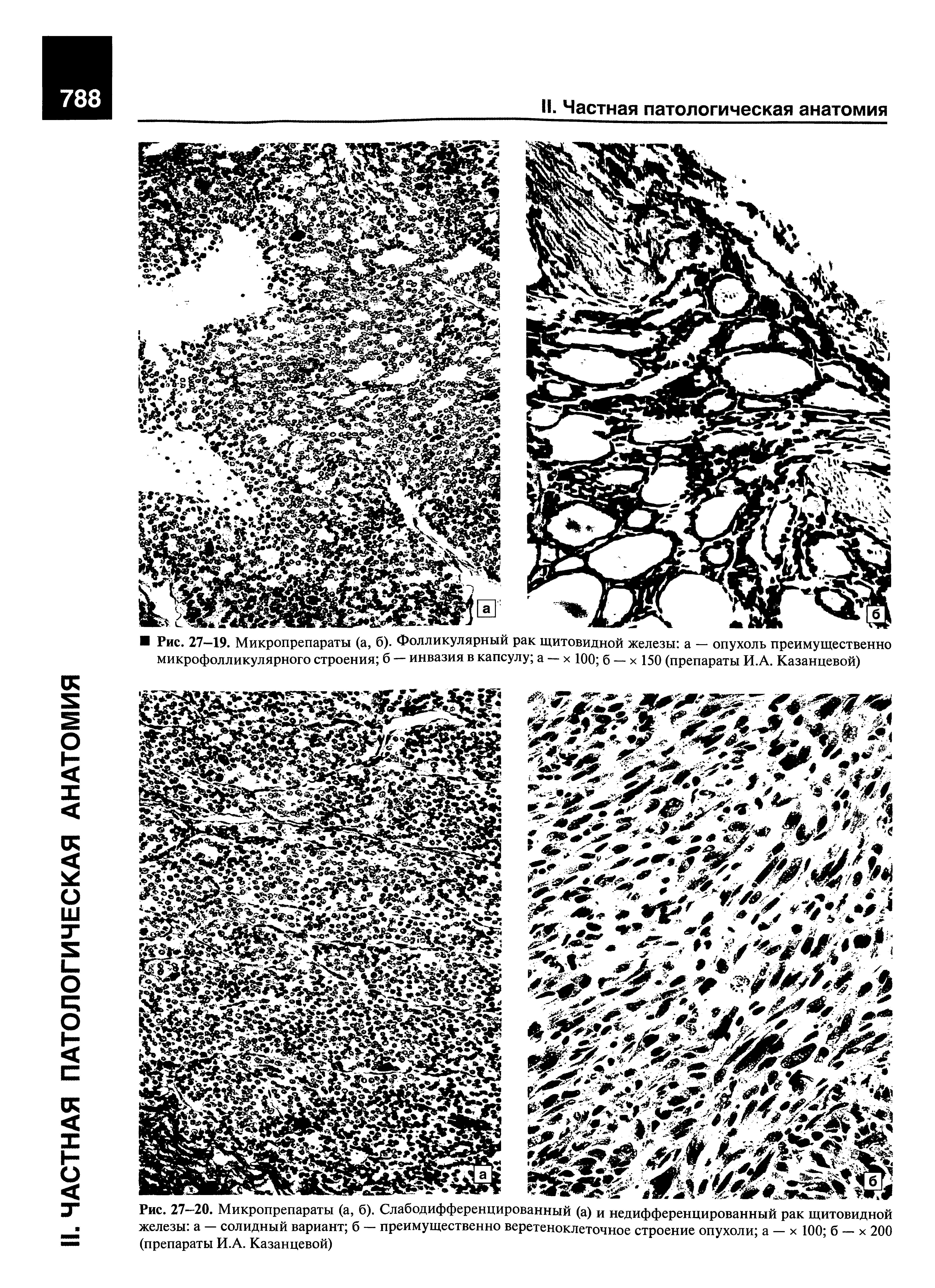 Рис. 27-20. Микропрепараты (а, б). Слабодифференцированный (а) и недифференцированный рак щитовидной железы а - солидный вариант б - преимущественно веретеноклеточное строение опухоли а - х 100 б - х 200 (препараты И.А. Казанцевой)...