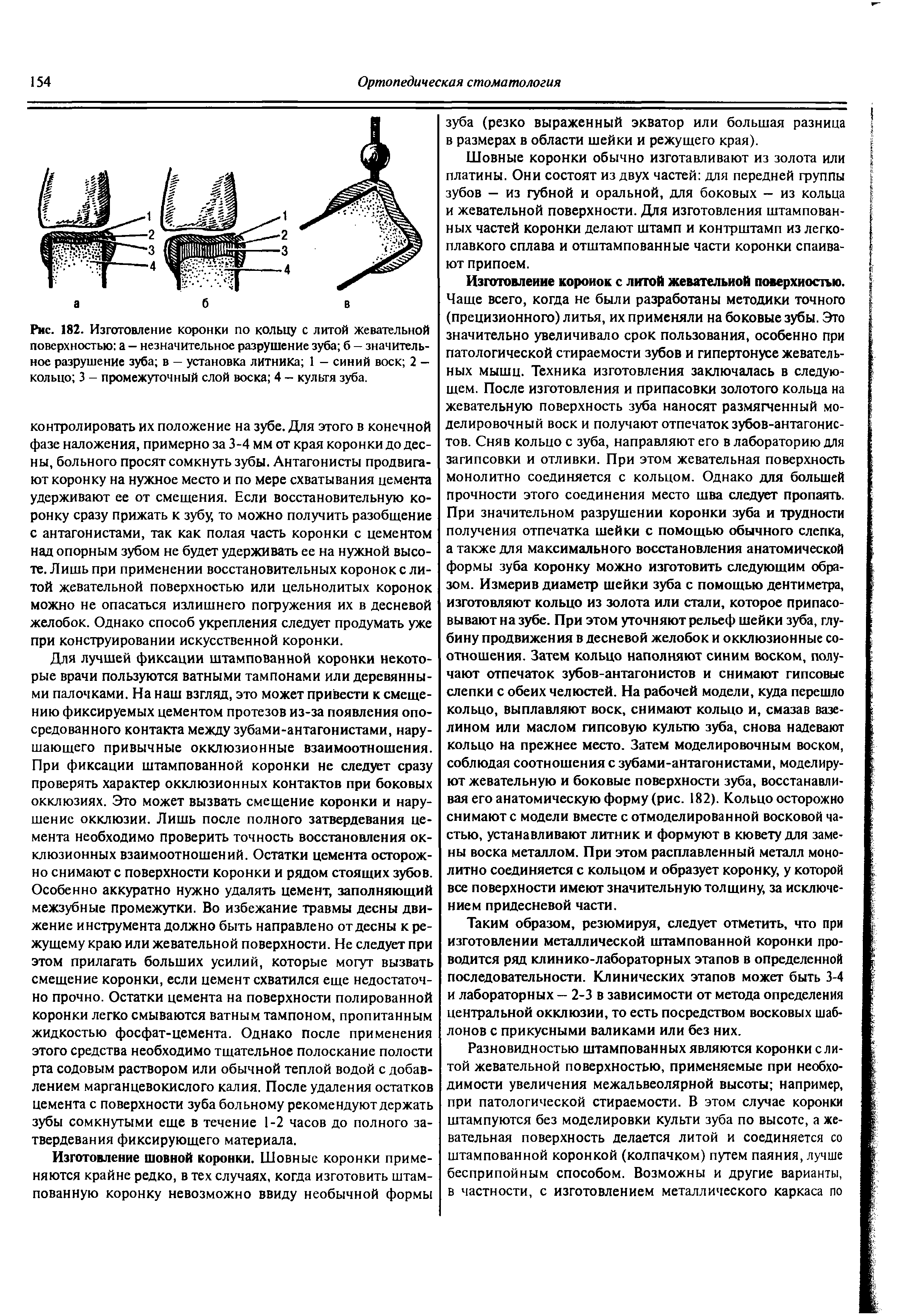 Рис. 182. Изготовление коронки по кольцу с литой жевательной поверхностью а - незначительное разрушение зуба б - значительное разрушение зуба в — установка литника 1 - синий воск 2 -кольцо 3 - промежуточный слой воска 4 - культя зуба.