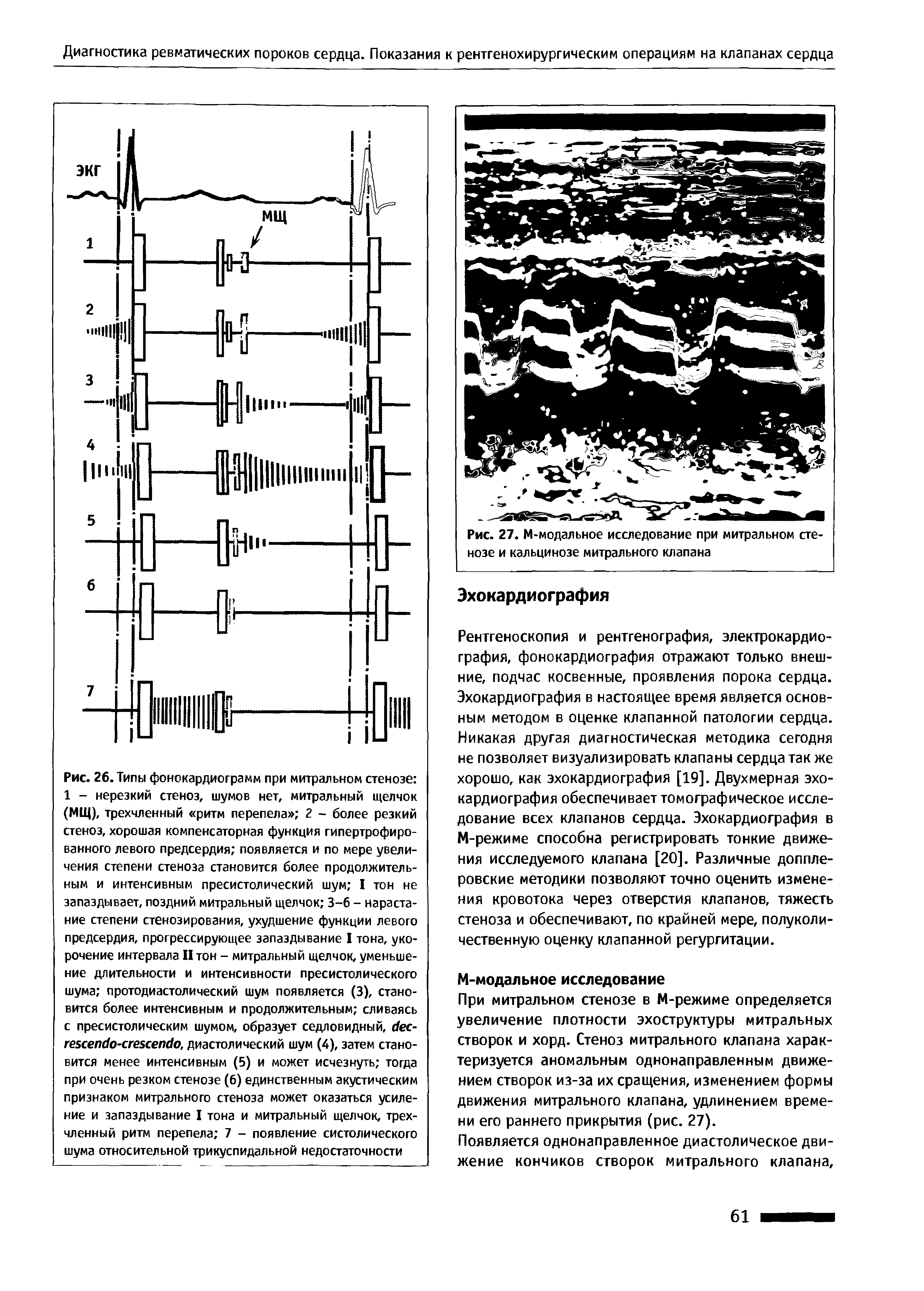 Рис. 27. М-модальное исследование при митральном стенозе и кальцинозе митрального клапана...