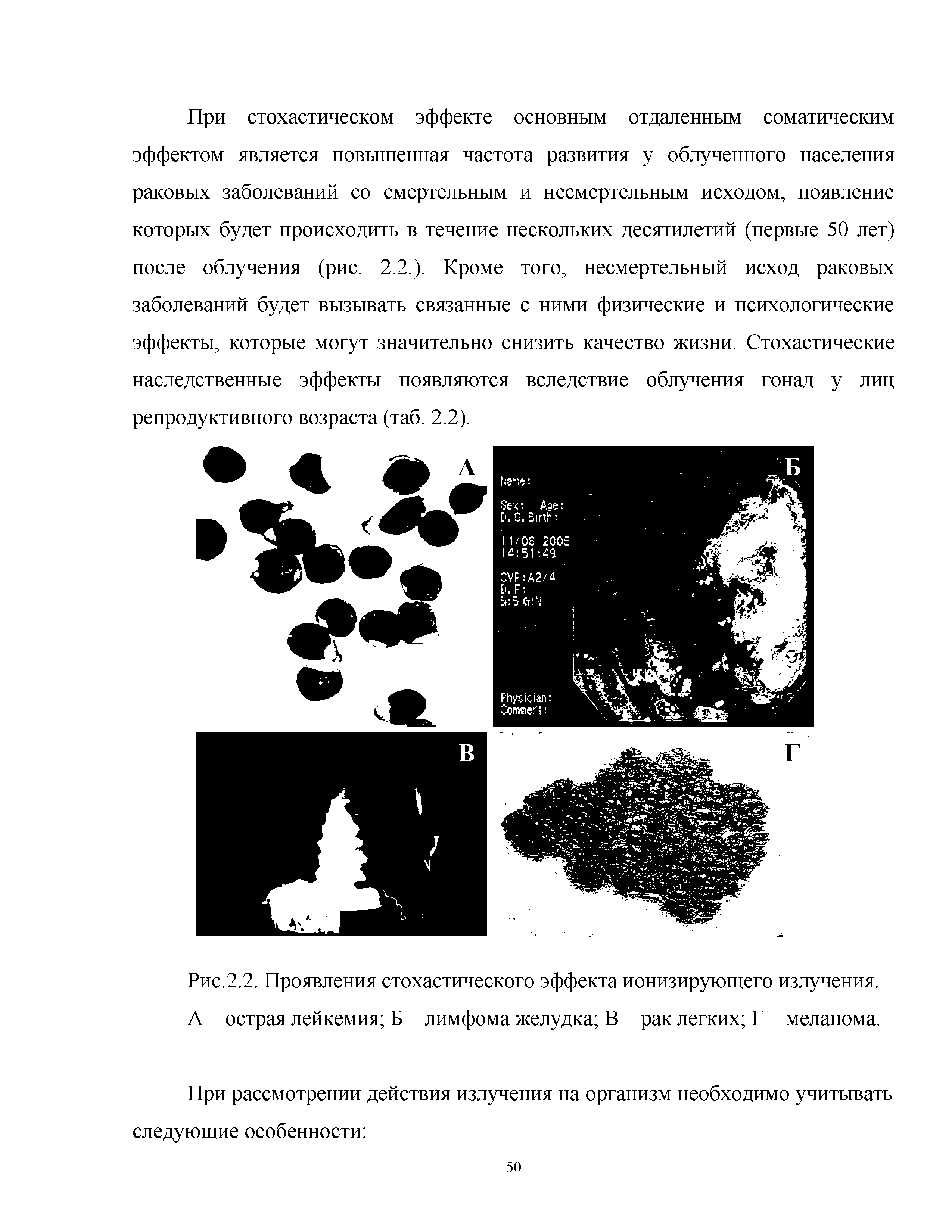 Рис.2.2. Проявления стохастического эффекта ионизирующего излучения. А - острая лейкемия Б - лимфома желудка В - рак легких Г - меланома.