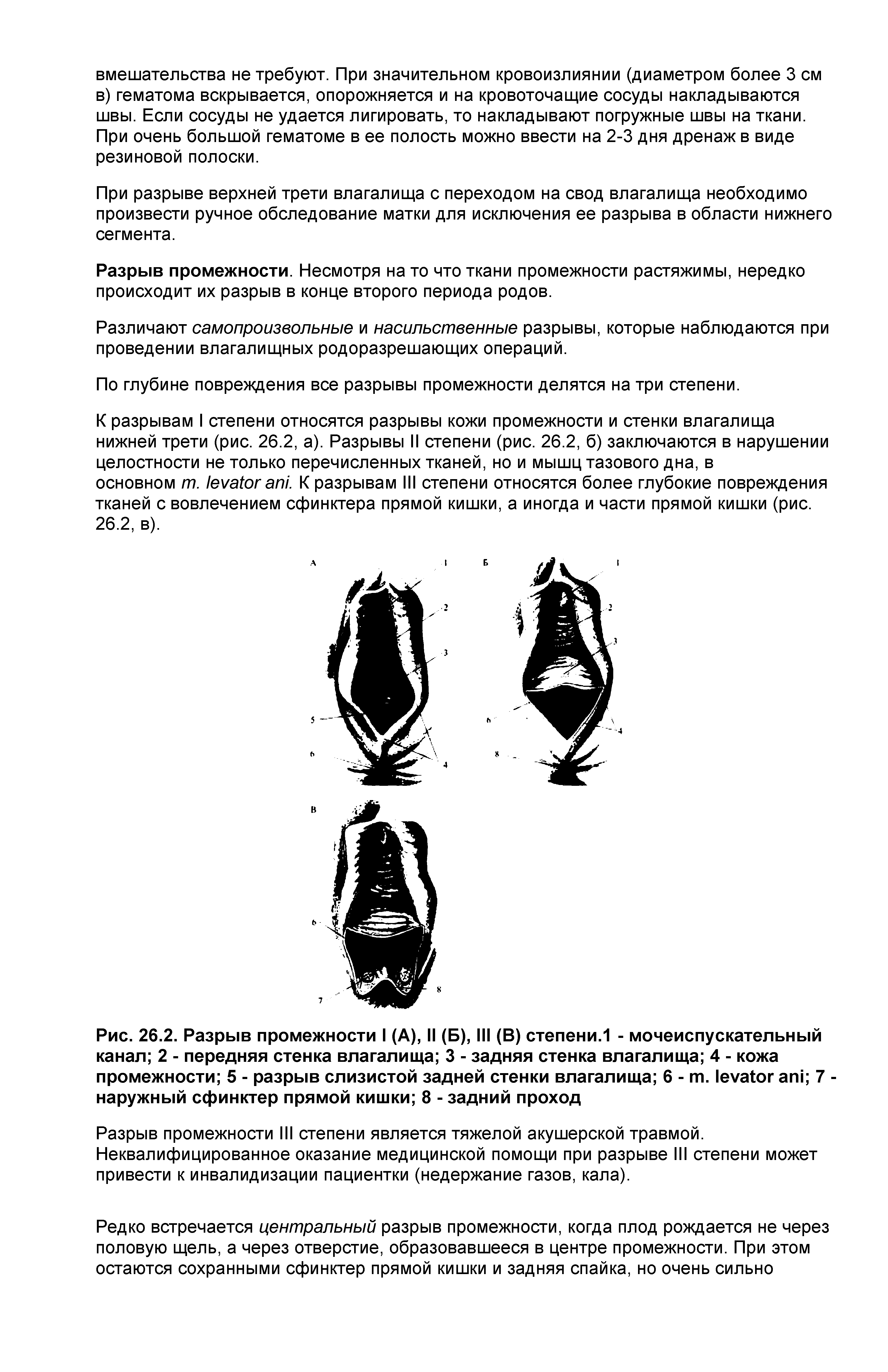 Рис. 26.2. Разрыв промежности I (А), II (Б), III (В) степени.1 - мочеиспускательный канал 2 - передняя стенка влагалища 3 - задняя стенка влагалища 4 - кожа промежности 5 - разрыв слизистой задней стенки влагалища 6 - . 7 -наружный сфинктер прямой кишки 8 - задний проход...