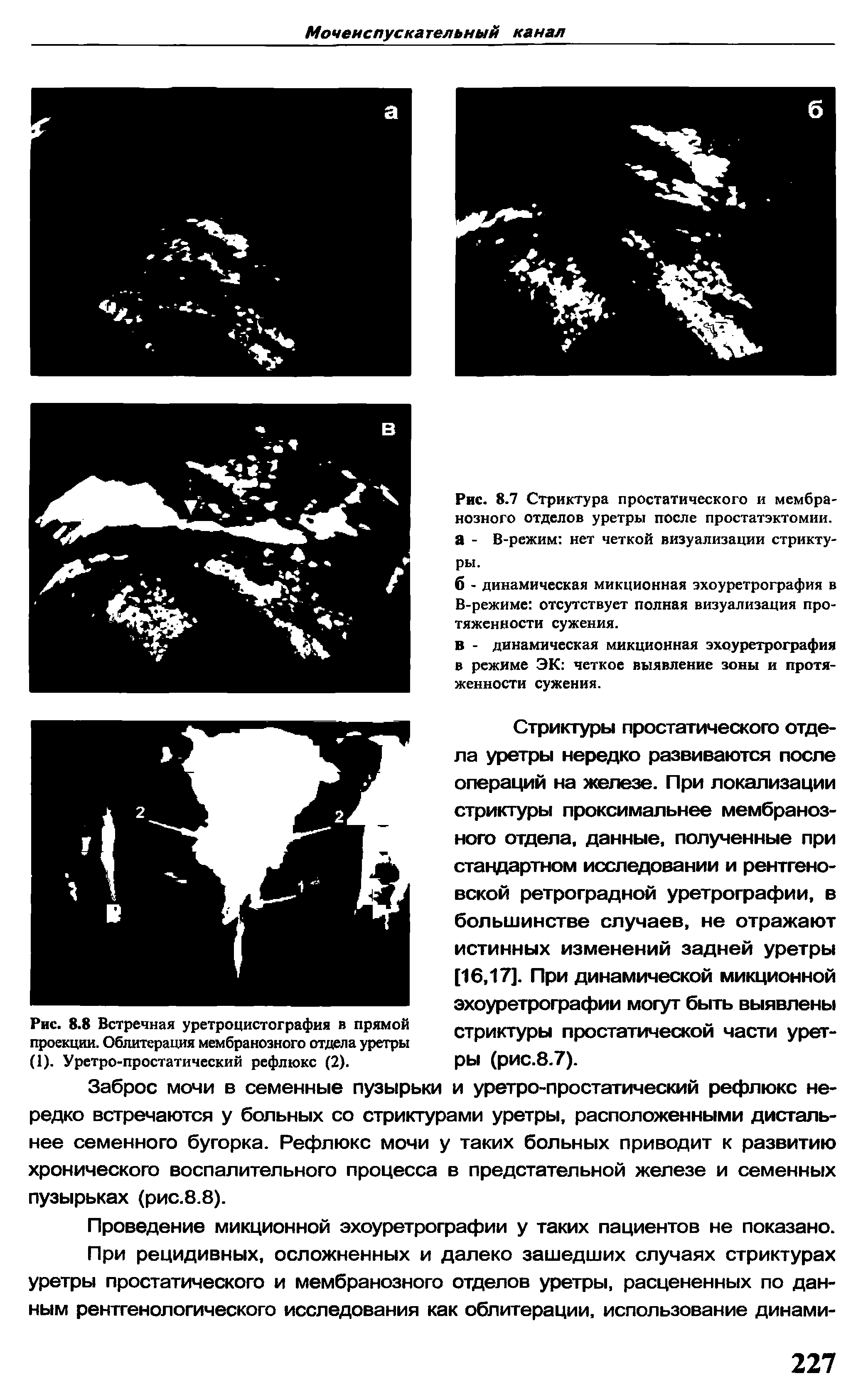 Рис. 8.8 Встречная уретроцистография в прямой проекции. Облитерация мембранозного отдела уретры (1). Уретро-простатический рефлюкс (2).