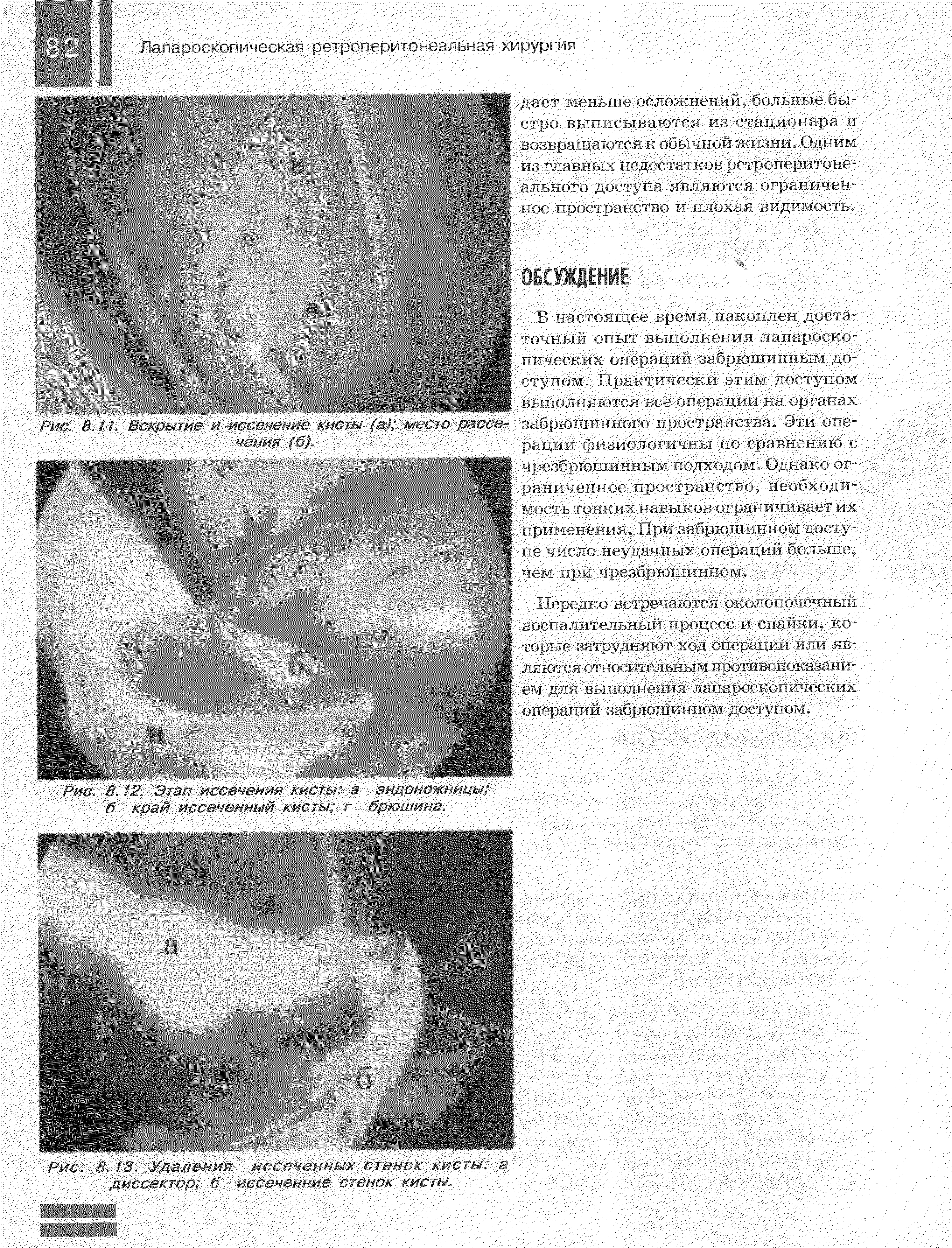 Рис. 8. 13. Удаления иссеченных стенок кисты а диссектор б иссеченние стенок кисты.