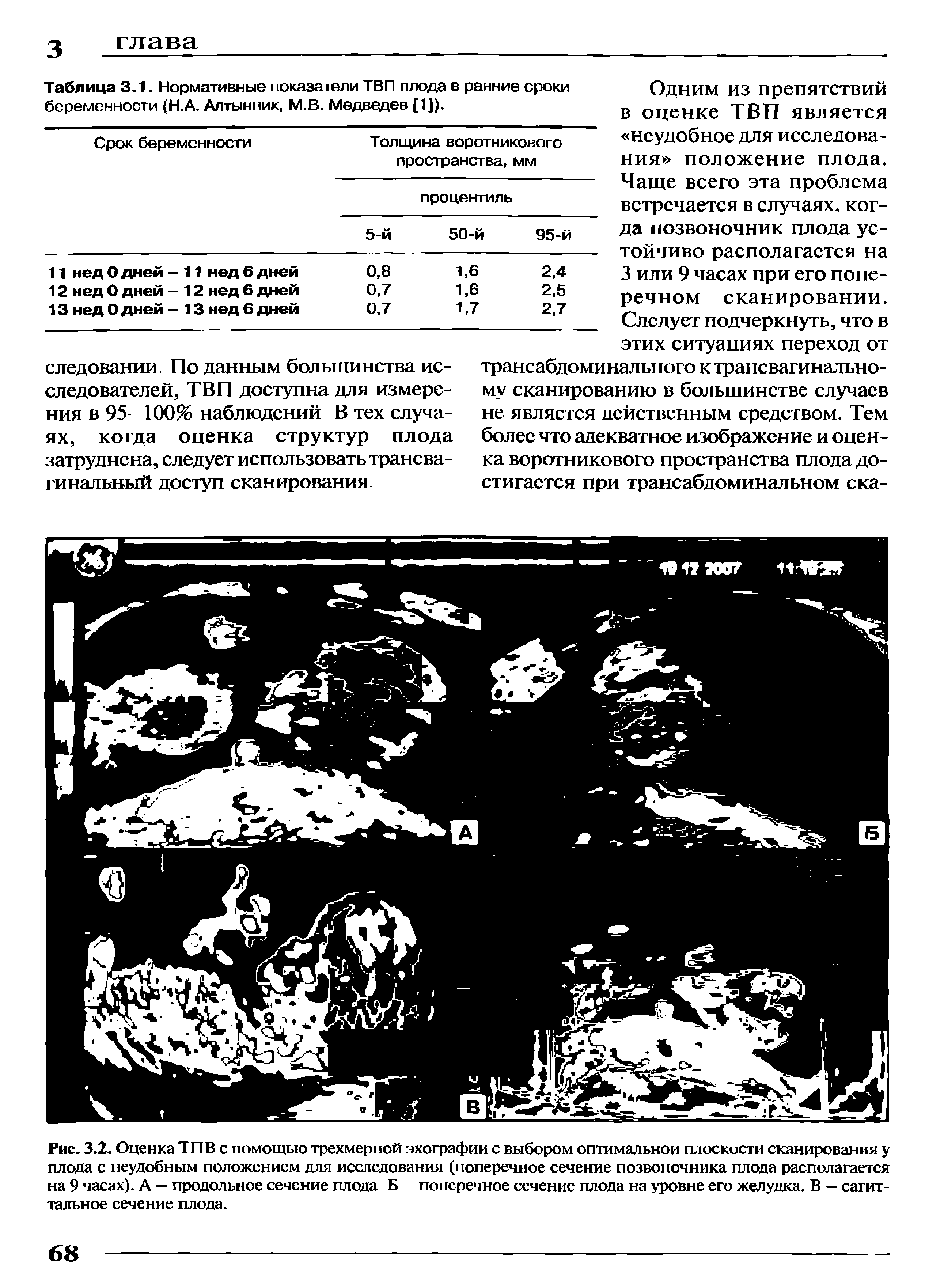 Рис. 3.2. Оценка ТПВ с помощью трехмерной эхографии с выбором оптимальной плоскости сканирования у плода с неудобным положением для исследования (поперечное сечение позвоночника плода располагается на 9 часах). А — продольное сечение плода Б поперечное сечение плода на уровне его желудка. В — сагиттальное сечение плода.