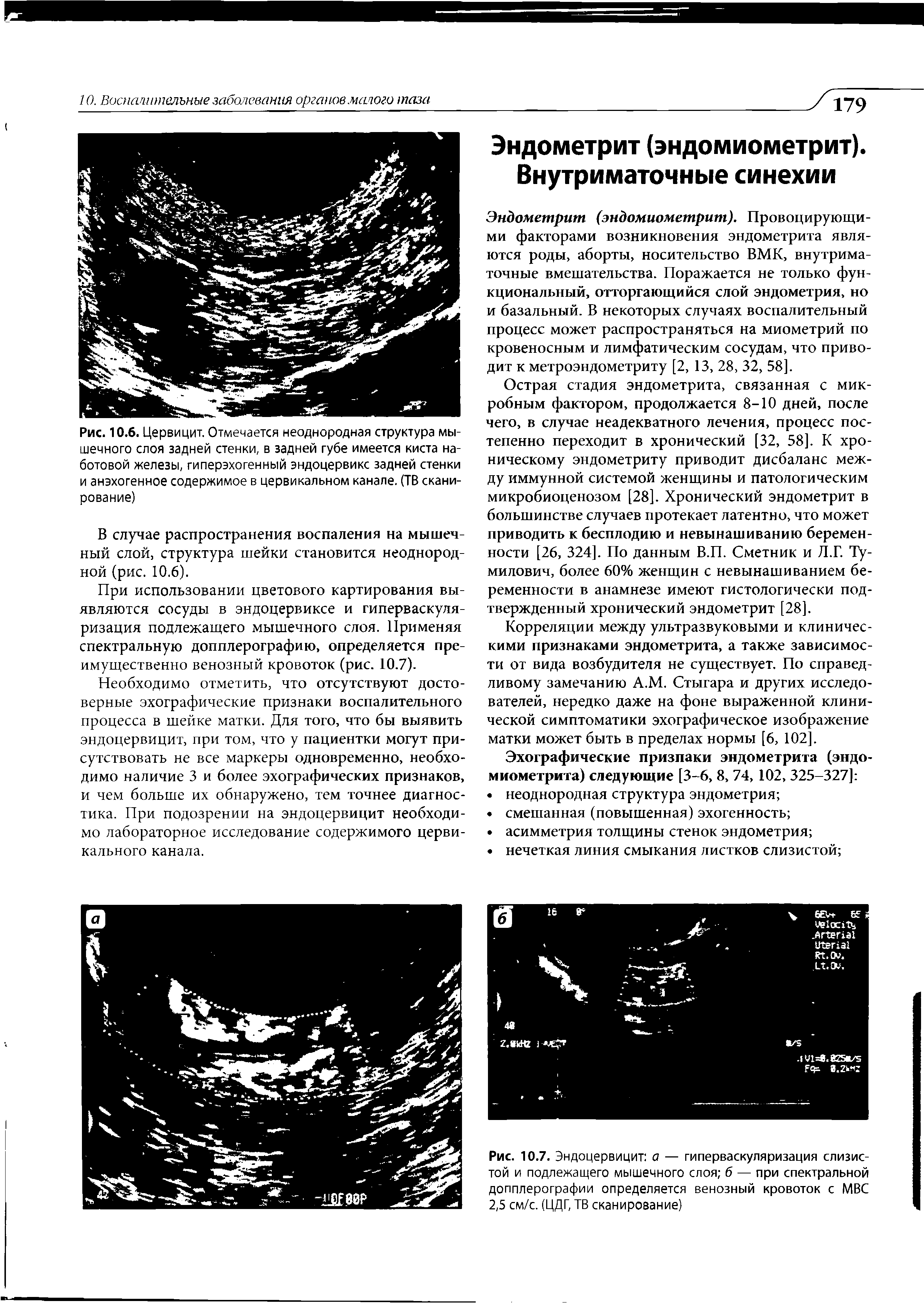Рис. 10.7. Эндоцервицит а — гиперваскуляризация слизистой и подлежащего мышечного слоя б — при спектральной допплерографии определяется венозный кровоток с МВС 2,5 см/с. (ЦДГ, ТВ сканирование)...