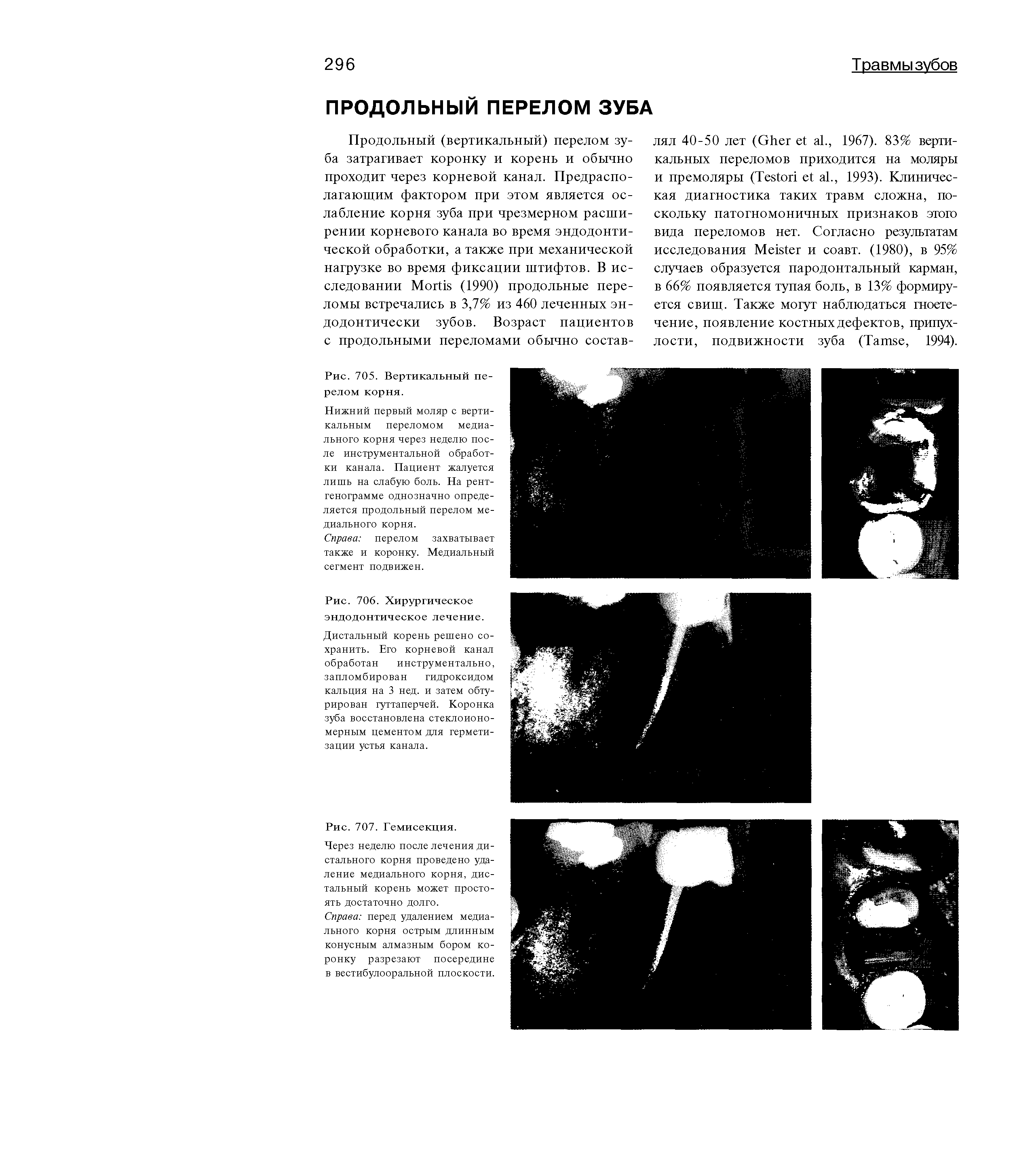 Рис. 706. Хирургическое эндодонтическое лечение. Дистальный корень решено сохранить. Его корневой канал обработан инструментально, запломбирован гидроксидом кальция на 3 нед. и затем обтурирован гуттаперчей. Коронка зуба восстановлена стеклоиономерным цементом для герметизации устья канала.