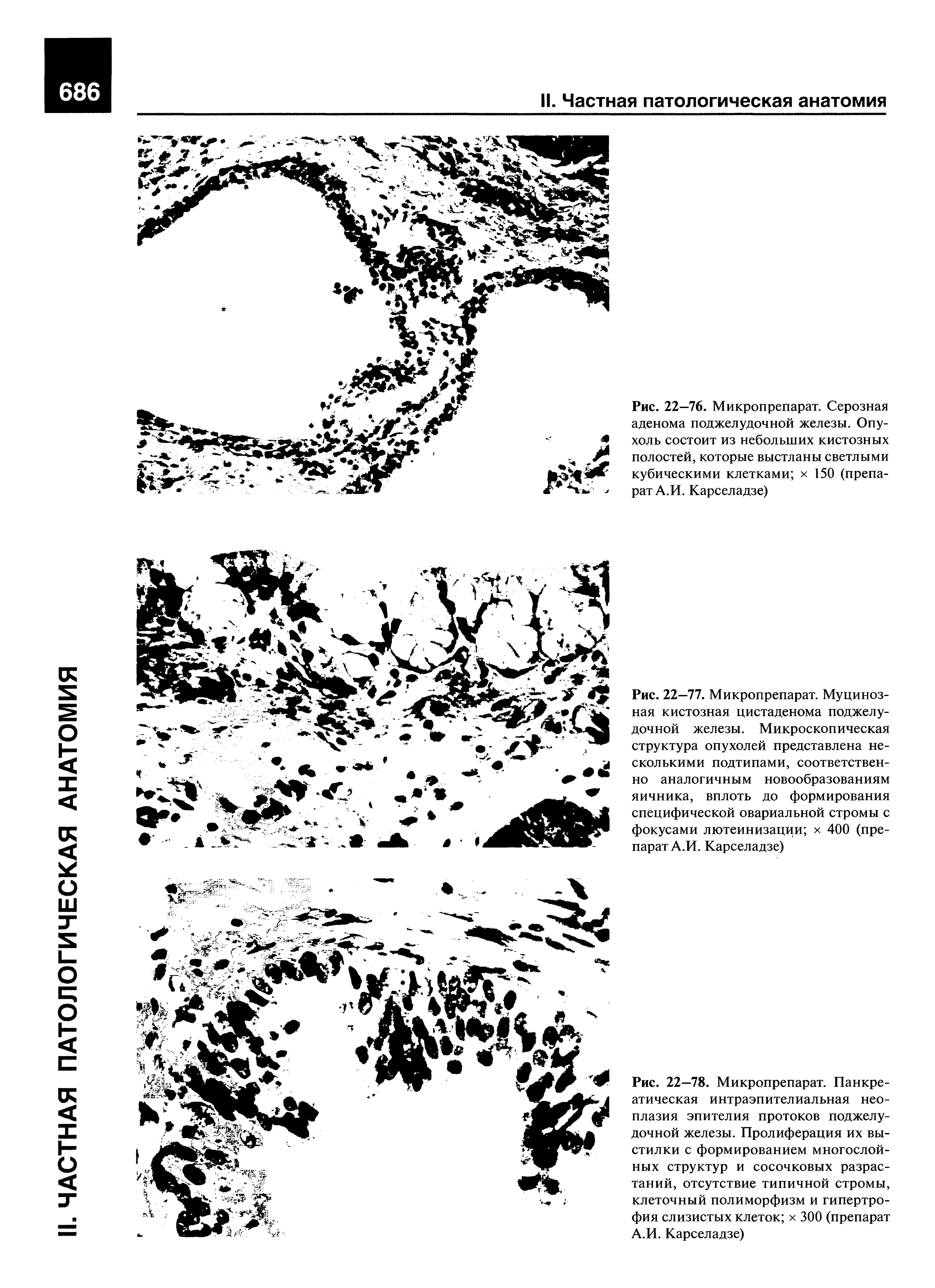 Рис. 22—76. Микропрепарат. Серозная аденома поджелудочной железы. Опухоль состоит из небольших кистозных полостей, которые выстланы светлыми кубическими клетками х 150 (препарат А.И. Карселадзе)...