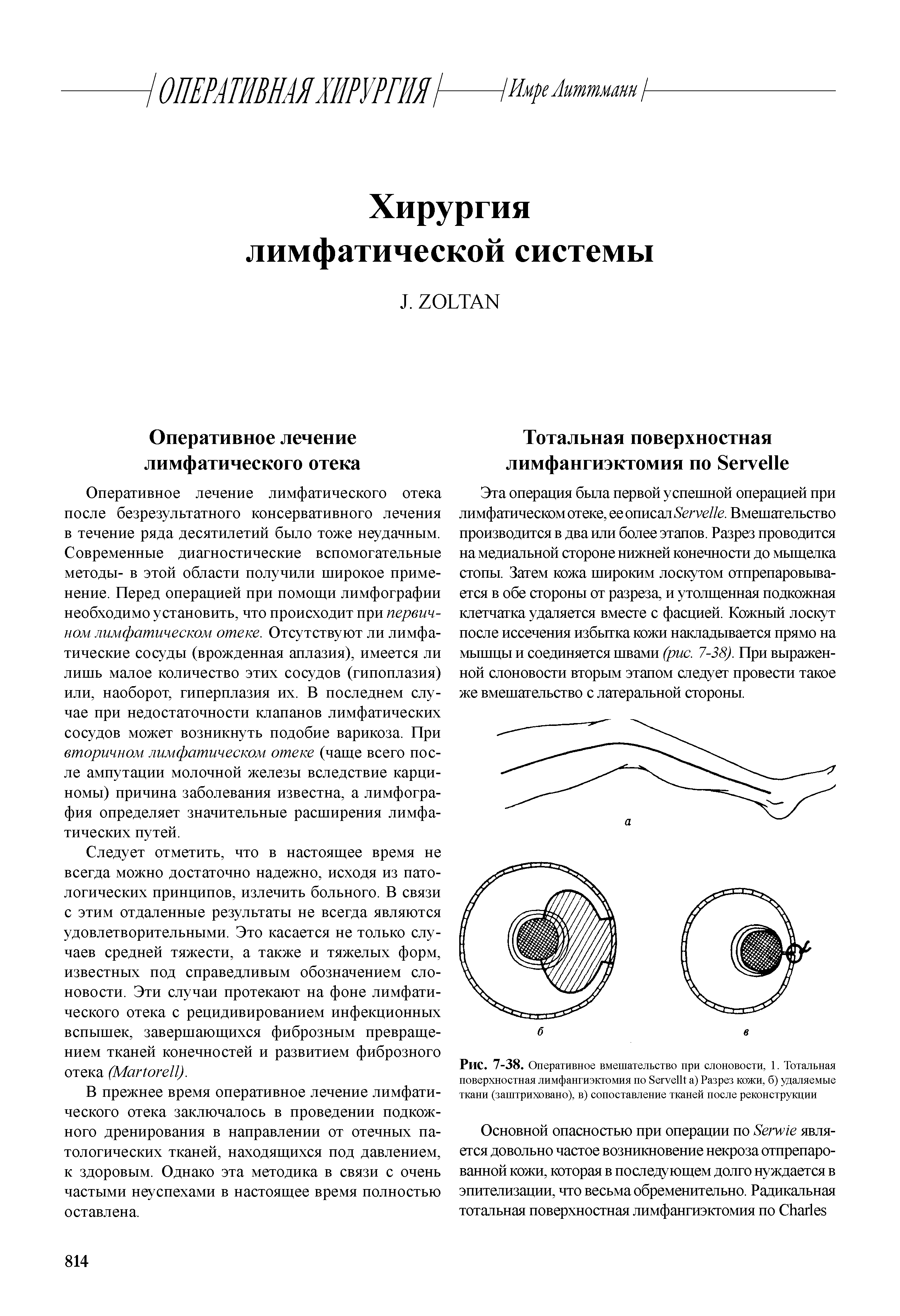 Рис. 7-38. Оперативное вмешательство при слоновости, 1. Тотальная поверхностная лимфангиэктомия по вегсеШ а) Разрез кожи, б) удаляемые ткани (заштриховано), в) сопоставление тканей после реконструкции...