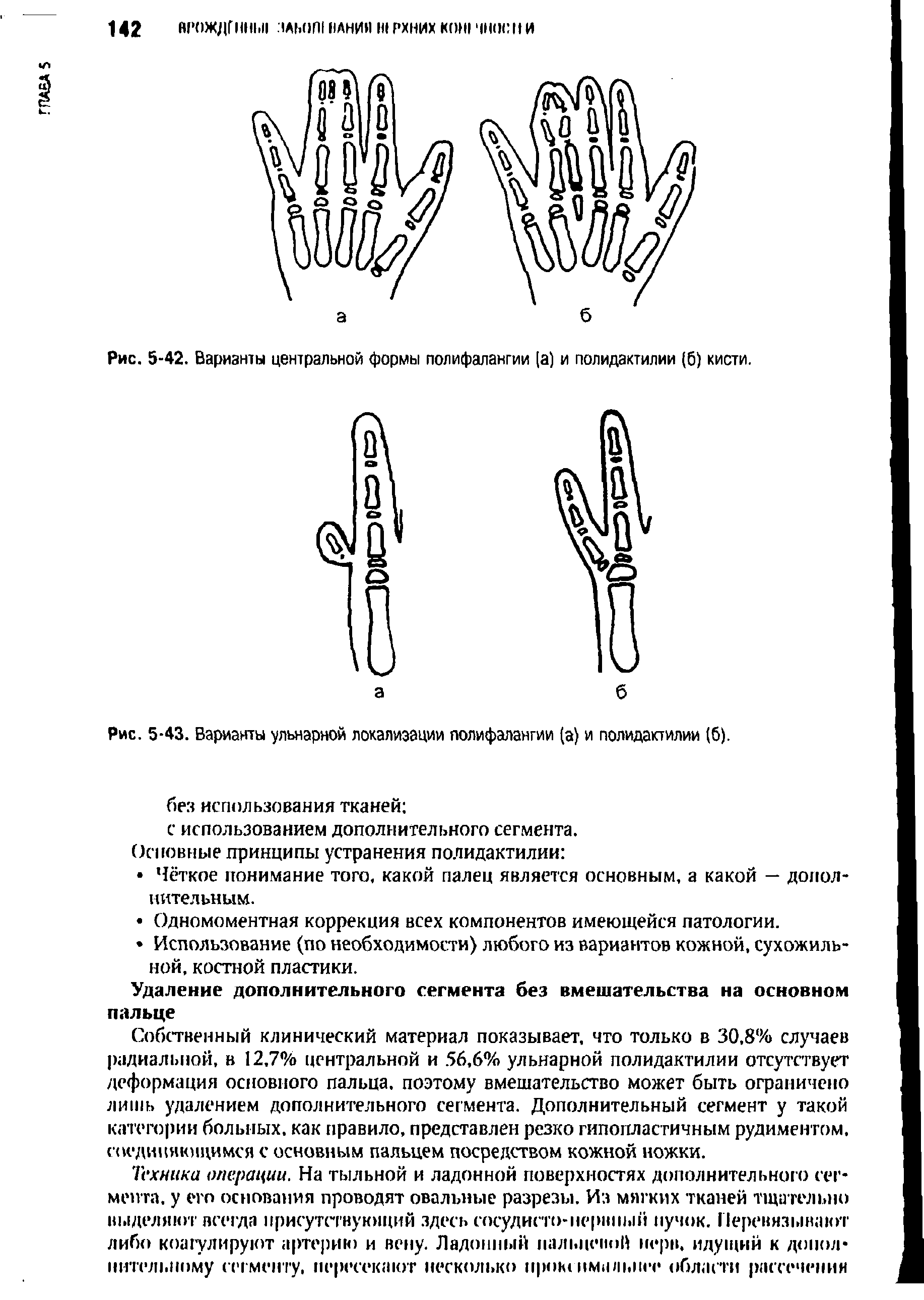 Рис. 5-42. Варианты центральной формы полифалангии [а] и полидактилии (б) кисти.