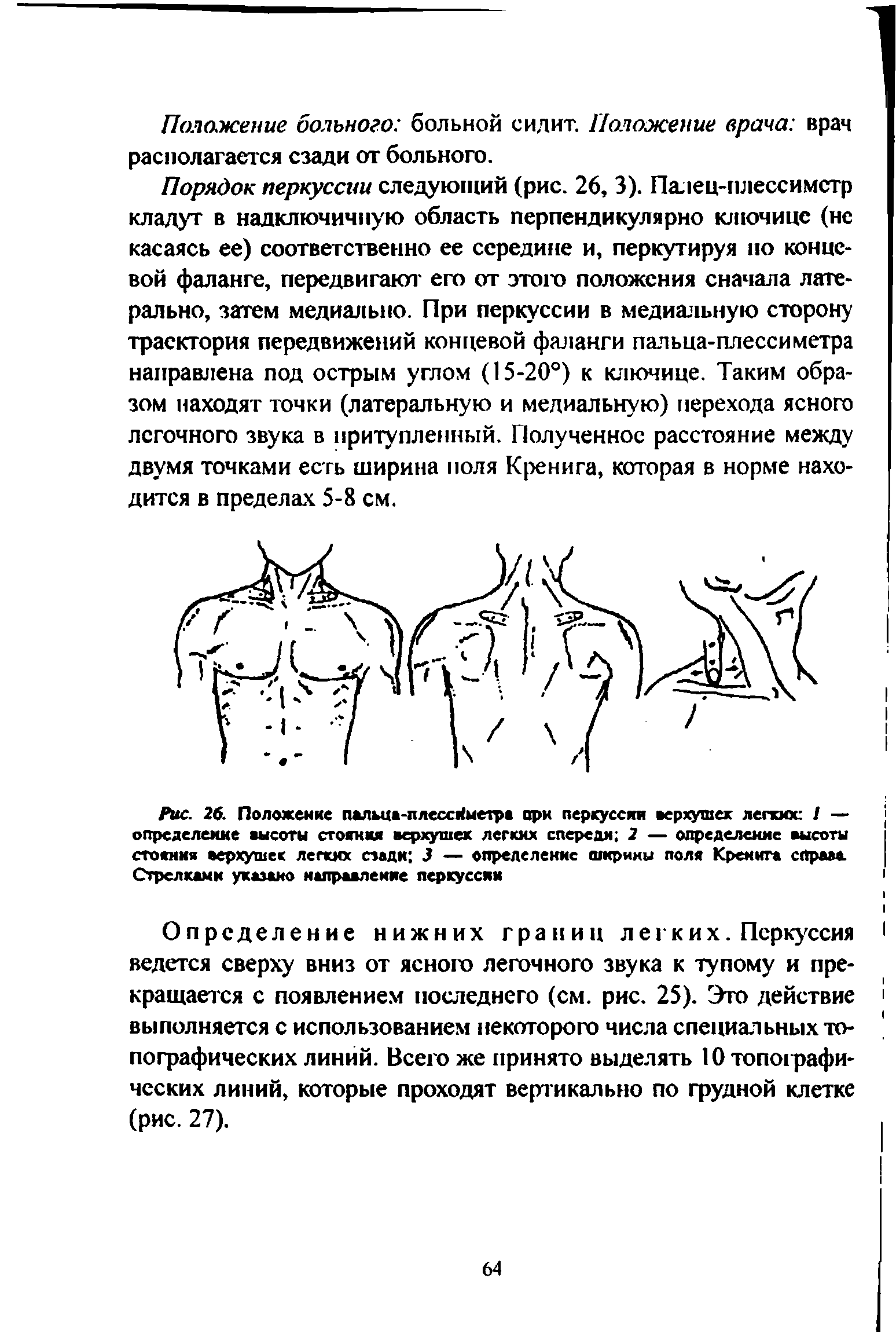 Рис. 26. Положение пальца-плессИметре при перкуссии верхушек легких / — определение высоты стояния аерхушех легких спереди 2 — определение высоты стояния верхушек легких сзади 3 — определение ширимы поля Кренига справа Стрелками указано направление перкуссии...