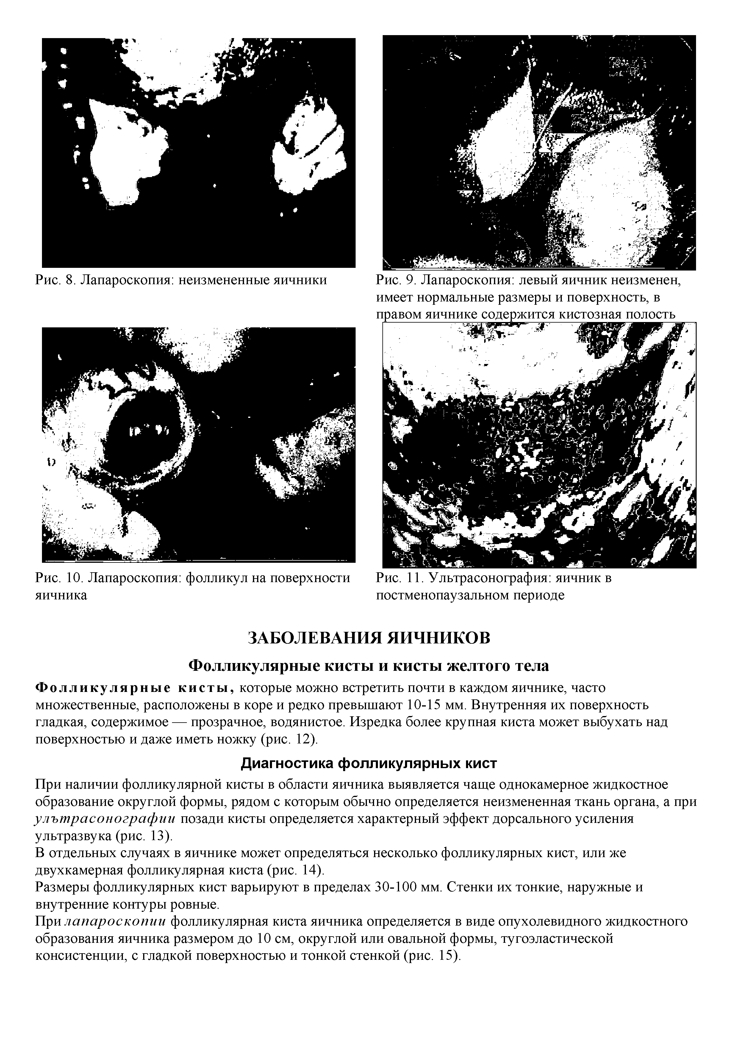 Рис. 9. Лапароскопия левый яичник неизменен, имеет нормальные размеры и поверхность, в правом яичнике содержится кистозная полость...