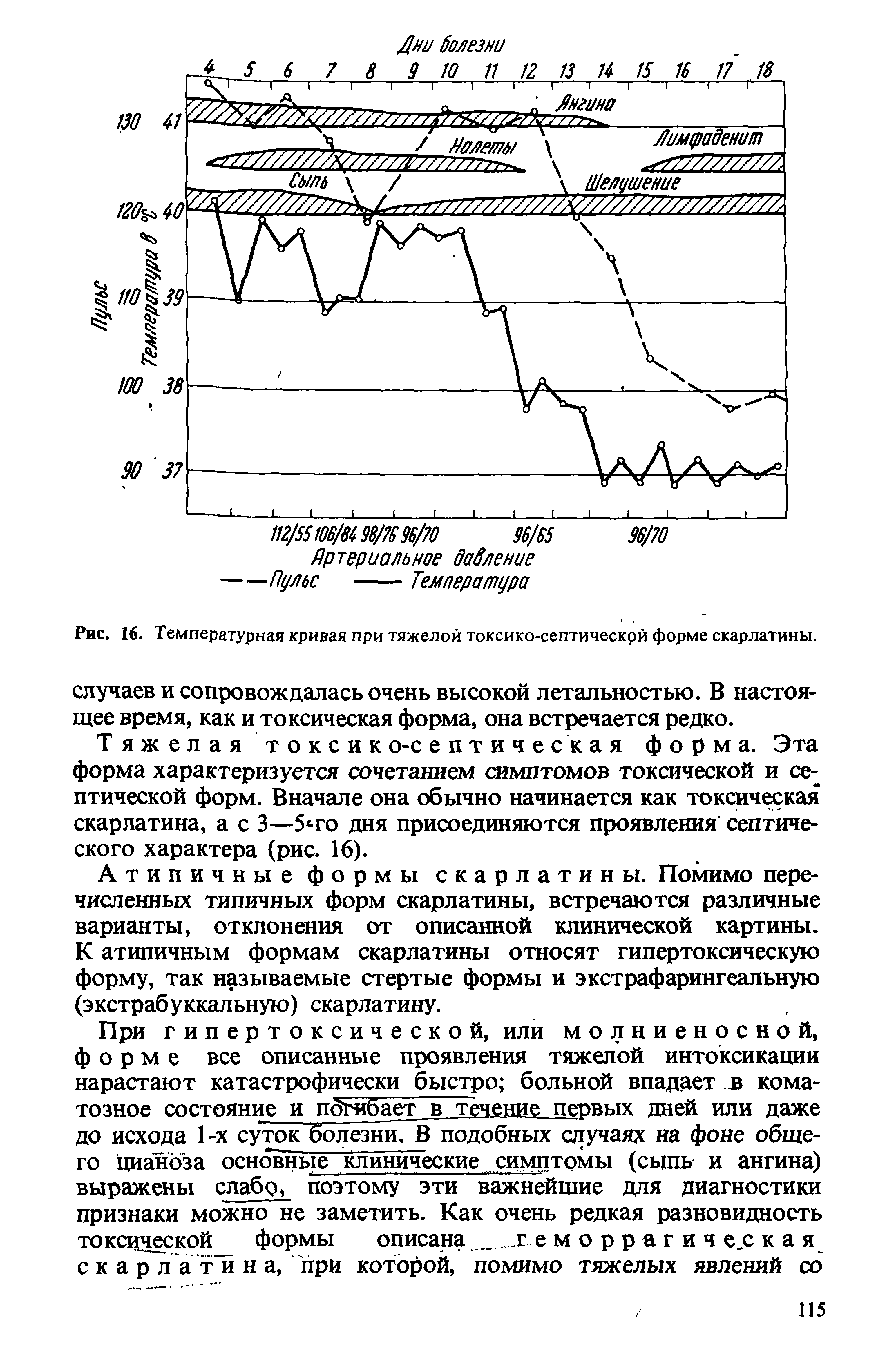 Рис. 16. Температурная кривая при тяжелой токсико-септической форме скарлатины.