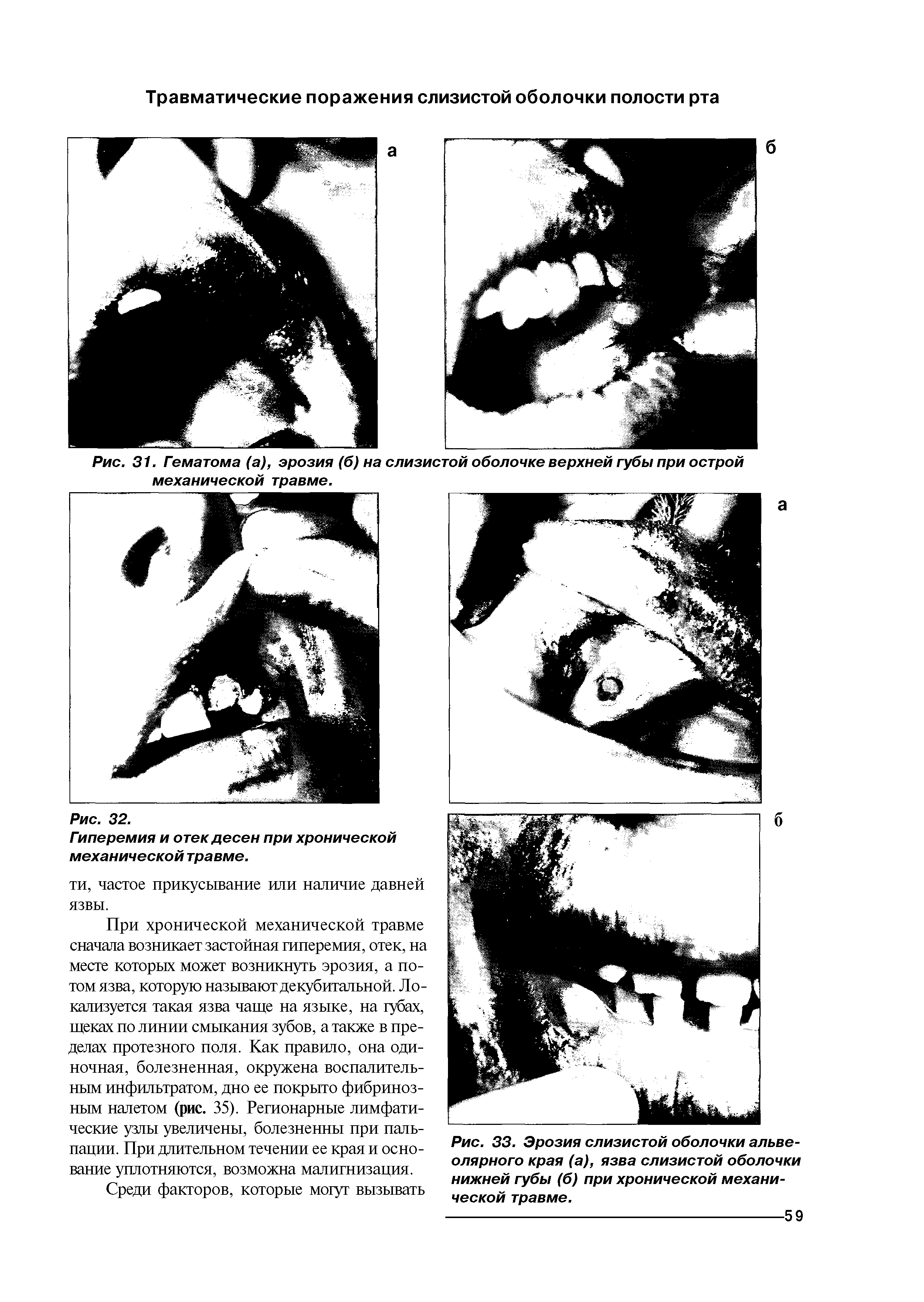 Рис. 33. Эрозия слизистой оболочки альвеолярного края (а), язва слизистой оболочки нижней губы (б) при хронической механической травме.